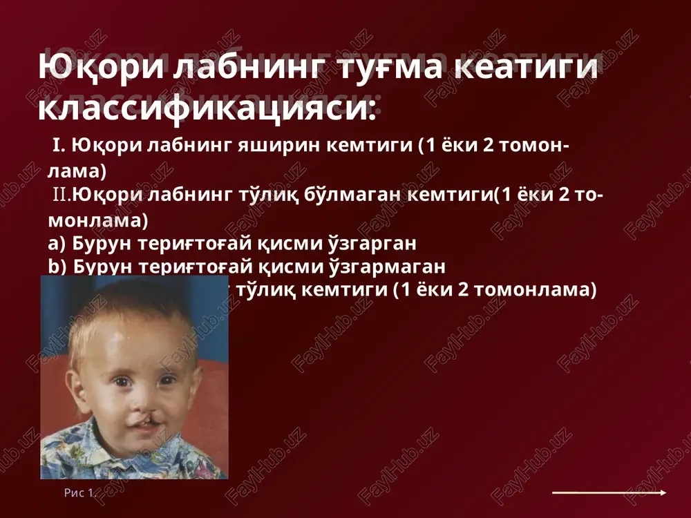 irus; b) bakteriya va toksinlari; 4. psixik faktor. endogen faktorlar: nasliy. xujayralarni noto'qri biologik bo'linishi . yosh va jins ta'siri. ortopedicheskaya pomosh pri vrojdennix rasshelinax tverdogo i myagkogo neba obturator po ilinoy-markosyan obturator po ilinoy-markosyan. eto obturator tverdogo i myagkogo neba, sostoyashiy iz dvux chastey: nebnoy plastinki i obturiruyushey chasti. nebnuyu plastinku izgotavlivayut iz tverdoy plastmassi akr-7, fiksiruyusheysya s pomoshyu klammerov. ona pokrivaet rasshelinu v zadney treti tverdogo neba i otchasti myagkoe nebo so storoni rotovoy polosti. etu chast plastinki izgotavlivayut iz slaboelastichnoy plastmassi (smes akr-7 i egmass-12). obturiruyushuyu chast izgotavlivayut iz egmass-12. ona imeet vid tonkoy plastinki, pokrivayushey vsyu rasshelinu myagkogo neba so storoni nosovoy polosti. obturiruyushaya i fiksiruyushaya chasti soedinyayutsya metallicheskoy knopkoy. v kachestve slepochnix mass luchshe primenyat elastichnie massi, naprimer algelast, kaltsinat i dr. obturatori, primenyaemie pri defektax myagkogo nyoba: a - pomerantsevoy-urbanskoy; b - ilinoy-markosyan; v - shildskogo; g - nyobnaya plastinka s obturi-ruyushey chastyu pri …