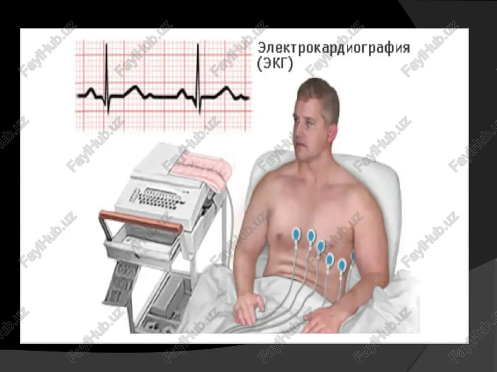 lari farqlanadi. ekstrosistoliyalar uchrashiga qarab bigemeniya, trigemeniya, kvadrigeminiya tarzida bo'lishi mumkin. chap qorincha ekstrosistoliyasi agar deformatsiyalangan qrs kompleksi ii, iii, avl , v5, v6 da uchrasa chap qorincha ekstrosistoliyasi deyiladi. o'ng qorincha ekstrosistoliyasi agar deformatsiyalangan qrs kompleksi ii, iii, avf, v1, v 2 da kuzatilsa o'ng qorincha ekstrosistoliyasi deyiladi. ikkala qorincha ekstrosistoliyasi qorinchali ekstrosistoliya polimorf qorinchali ekstrosistoliyalar paroksizmal taxikardiya to'gri regulyar ritm saqlangan xolda, to'saddan boshlovchi va to'saddan to'xtovchi , minutiga 150 dan 250 tagacha etuvchi yurak o'ynashi xuruji xisoblanadi. xuruj odatda bir necha sekunddan bir necha soatgacha , ba'zida esa bir sutkagacha davom etishi mumkin. paroksizmal taxikardiya muxum belgisi to'g'ri ritmni saqlanib qolishi, yuqs doimiy bo'ladi. sinusli taxikardiyadan farqli ravishda jismoniy va ruxiy zo'riqish chog'ida, chuqur nafas olganda va atropindan so'ng yuqs o'zgarmaydi. ektopik markaz joylashuviga qarab 3 xil: bo'lmachali pt atrioventrikulyar pt qorincha pt bo'lmacha paroksizmal taxikardiyasi bo'lmacha paroksizmal taxikardiyasi yurak ritmi buzilishi bilan bog'liq kasalliklar orasida eng …