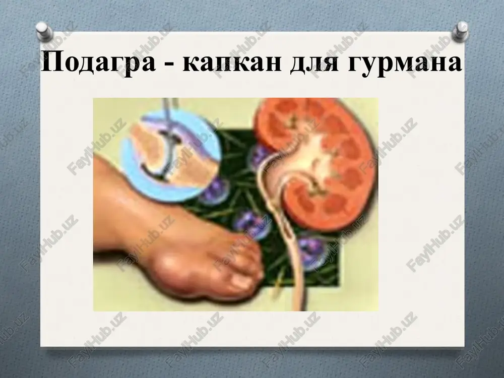 m, a nochyu prosipaetsya ot silneyshey jguchey davyashey pulsiruyushey, rvushey boli v odnom ili neskolkix sustavax. ostriy artrit pervogo plyusnefalanogovogo sustava (bolshogo paltsa) stopi ostriy podagricheskiy artrit v debyute bolezni chashe porajayutsya sustavi nog, v osnovnom tipichna asimmetrichnost porajeniy. s ubivayushey chastotoy v podagricheskiy protsess vovlekayutsya sustavi stop. golenostopnie, kolennie, paltsev ruk, loktevie i dr. u 60-75 % bolnix pervie proyavleniya podagri voznikayut v pervom plyusnefalangovom sustave bolshogo paltsa. reje bolezn nachinaetsya po tipu poliartrita. podagricheskie tofusi mnojestvennie tofusi programma obsledovaniya obshiy analiz krovi i mochi bioximicheskiy analiz: obshiy belok, belkovie fraktsii, sialovie kisloti, mochevaya kislota, mochevina, kreatinin proba reberga i zimnitskogo rentgenografiya porajennix sustavov opredelenie sutochnoy ekskretsii s mochoy i klirensa mochevoy kisloti laboratornie dannie obshiy analiz krovi: vne pristupa bez izmeneniy, vo vremya pristupa – neytrofilniy leykotsitoz so sdvigom vlevo, povishenie soe bioximiya: v periode obostreniya povishenie seromukoida, fibrina, gaptoglobina, sialovix kislot, mochevoy kisloti instrumentalnie issledovaniya rentgenografiya sustavov …
