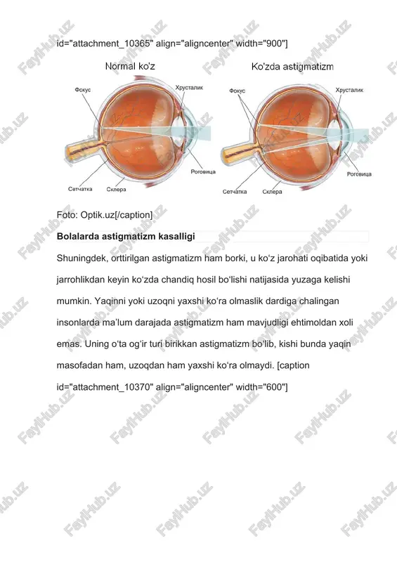 ar ota-onalar yoki bobo-buvilarda astigmatizm bo‘lsa, u irsiyat orqali ham o‘tishi mumkin. ko‘z jarohatlangan yoki shikastlangan, shuningdek, xastalikka chalingan taqdirda esa bolakaylarda astigmatizm darajasi yanada ortishi yuz beradi. bolalar astigmatizmining xavfli jihati [caption id="attachment_10372" align="aligncenter" width="653"]foto: shutterstock.com[/caption] bolalar astigmatizmining xavfli jihati, uning ta’sirida miya faoliyati bilan bog‘liq tarzda ko‘rish qobiliyatining susayishi sodir bo‘ladi. agar yorug‘lik shu’lasi to‘r pardada fokuslanmasa, miya aniq tasvirdan mahrum bo‘ladi. bunday paytda ko‘rish qobig‘i hujayralari rivojlanishdan to‘xtaydi, miya ko‘rish signallariga ishlov bera olmaydi va ko‘ruv yomonlashadi. ayni nuqsonli holatlarga chek qo‘yish uchun maxsus yoki bir tomoni to‘silgan oddiy ko‘zoynaklardan foydalaniladi. aytilishicha, xastalangan ko‘zning to‘silmagan holda ochiq turishi miya faoliyatini kuchaytirish va ko‘rishni yaxshilashga xizmat qilar ekan. biroq sog‘lom ko‘zning yopib qo‘yilishi kuniga bir necha soatdan oshmasligi kerak. aks holda bu ko‘z ham kasallanishi, ko‘rish faoliyatining sustlashishi yuz berishi mumkin. 1 yoshgacha bo‘lgan bolakaylarda astigmatizm xastaligini aniqlash nihoyatda qiyin kechadi. shu bois ularni 3, 6 va 12 …