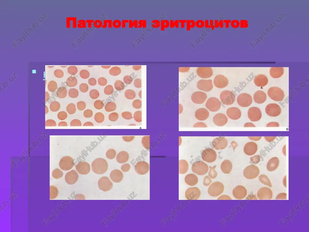 ojnoy kletchatke; cherez gipoksiyu tkani voznikaet jirovaya distrofiya miokarda (tigrovoe sertse), pecheni, pochek, distroficheskie izmeneniya v kore golovnogo mozga. anemii pri narushenii krovetvoreniya obuslovleni defitsitom dlya eritropoeza veshestv ili patologiey regeneratsii krovetvornoy tkani. 1) jelezodefitsitnie a. vsledstvii alimentarnoy nedostatochnosti jeleza; b. vsledstvii ekzogennoy nedostatochnosti jeleza v. vsledstvii rezorbtsionnoy nedostitatochnosti tonkoї kishki) g. idiopaticheskaya 2) obuslovlena narusheniem sinteza ili utilizatsiey porfirinov. a. nasledstvennie b. nasledstvennie(otravlenie svintsom, defitsit vitamina v6) 3) obuslovlennie narusheniem sinteza dnk і rnk – megaloblasticheskie anemii. a. vsledstvii defitsita vitamina v12 (zlokachestvennaya ili pernitsioznaya ); b . vsledstvii defitsita folievoy kisloti: v. nasledstvennie anemii, obuslovlennie narusheniem aktivnosti fermentov, kotorie prinimayut uchastie v v sinteze purinovix i pirimidinovix osnov. 4) gipoplasticheskaya i aplasticheskaya anemiya , vizivaetsya endogennimi i ekzogennimi ili nasledstvennimi faktorami. obshie morfologicheskie proyavleniya anemiy, obuslovlennix narusheniyami krovetvoreniya stromalno-sosudistie izmeneniya: otek i fibroz stromi v organax, diapedeznie krovoizliyaniya, gemosideroz; izmeneniya parenximatoznix elementov: distrofiya i atrofiya; kompensatornie proyavleniya v …