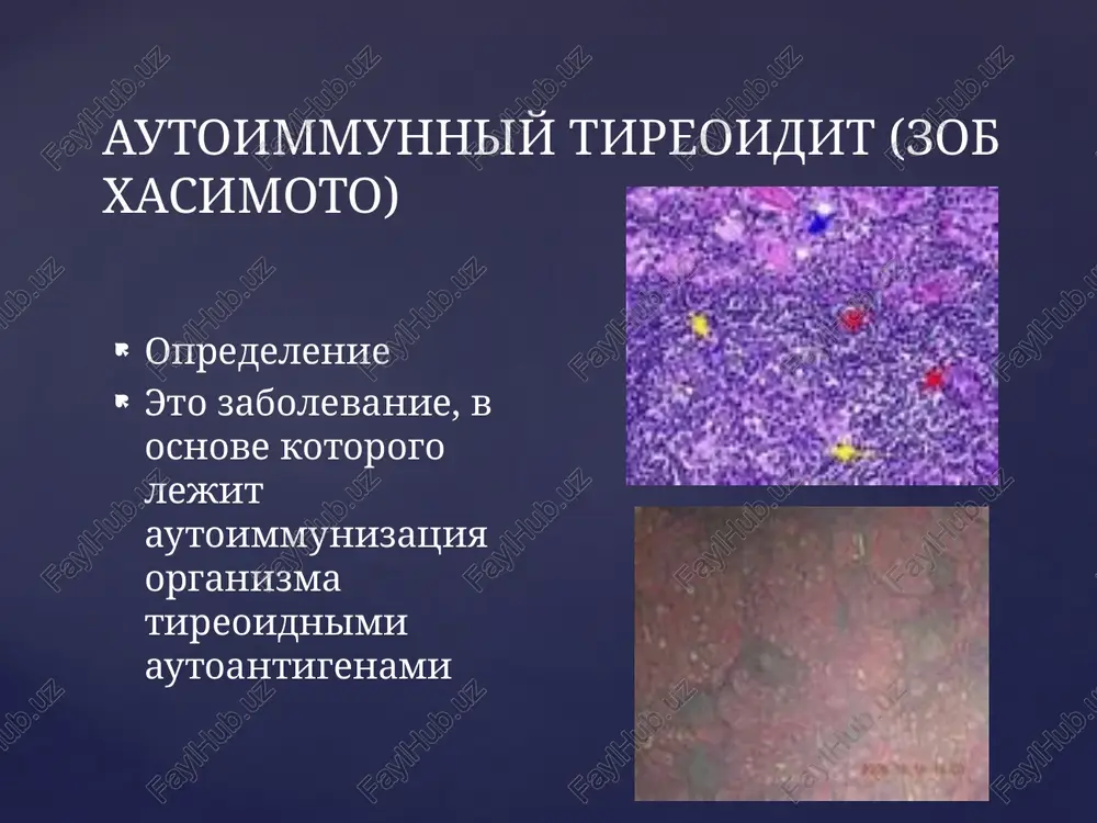 shitovidnoy jelezi, uplotnenie mojet bit v vide otdelnix uzlov ili mnojestvennix uchastkov. shitovidnaya jeleza podvijna, ne spayana s okrujayushimi tkanyami. mogut bit uvelicheni regionarnie limfaticheskie uzli. techenie zabolevaniya medlennoe, klinicheskaya simptomatika skudna, nachalnie stadii proyavlyayutsya simptomami legkogo-tireotoksikoza, zatem nastupaet eutireoidnoe sostoyanie, smenyayusheesya klinikoy gipotireoza. autoimmunniy tireoidit mojno rassmatrivat kak osnovnuyu prichinu “spontannogo” gipotireoza. u chasti bolnix razvivaetsya oftalmopatiya autoimmunnogo geneza. ob'ektivniy osmotr diagnostika gemogramma xarakterizuetsya: limfotsitoz umensheniem kolichestva monotsitov. anemiya gipergammaglobulinemiya. na rannix stadiyax zabolevaniya pogloshenie j 131 shitovidnoy jelezoy povisheno. po mere progressirovaniya bolezni snijaetsya pogloshenie radioaktivnogo yoda shitovidnoy jelezoy. pri skanirovanii opredelyayutsya uchastki povishennogo poglosheniya izotopa i uchastki snijeniya poglosheniya izotopa za schet limfoidnoy infiltratsii. pri ultrazvukovom skanirovanii kartina takje neodnorodna - nablyudayutsya exonegativnie i exopozitivnie strukturi. differentsiruyut autoimmunniy tireoidit s uzlovim eutireoidnim zobom, rakom shitovidnoy jelezi, diffuznim toksicheskim zobom, fibroznim tireoiditom ridelya. uzlovoy eutireoidniy zob. obshie priznaki: uvelichenie shitovidnoy jelezi, nalichie plotnogo uzla, podvijnost i bezboleznennost jelezi. …