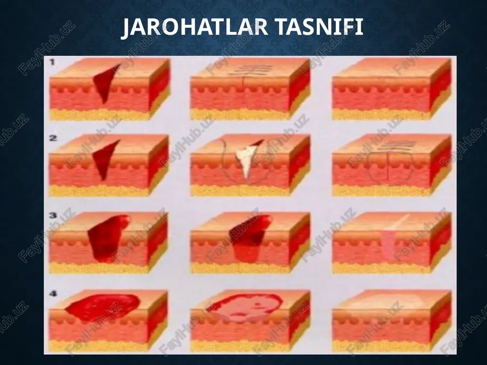 o'zgarishlar. jarohatning chuqurligiga qarab, yuza, teshib o'tgan jarohat va a'zolarning shikastlanishi farq qilinadi. masalan, teri, teri osti va qorin mushaklari shikastlanishi yuza jarohatlarga kiradi, agar qorin pardasi shikastlansa, teshib o'tgan jarohat hisoblanadi. shikastlanishda ichki organlar, masalan, jigar, taloq yoki boshqa organlar jarohatlansa, unda jarohat asoratli hisoblanadi. shikastlangan to'qima va organlarga qarab, yuz kalla, bo'yin, qo'l-oyoq jarohatlari farqlanadi, ya'ni ular aseptik va infeksiya tushgan jarohatlarga bo'linadi. aseptik jarohatlarga operatsiya yoki birlarnchi yordam berilgan jarohatlar, shartli ravishda kesilgan yoki chopilgan jarohatlar kiradi. qolgan jarohatlar teri va atrofdagi narsalar orqali infeksiya tushganligi uchun ifloslangan, ya'ni infeksiya tushgan jarohatlar hisoblanadi. shuningdek, jarohatlar yangi yoki kechikkan bo'ladi. yangi jarohat deb, shikastlanish ro'y bergandan keyin 24 soat ichida bcmorga yordam ko'rsatilishiga aytiladi. bu davr ichida jarohat chekkalari kesib olinib, jarohat infeksiyasining oldini olish mumkin va ifloslangan jarohatni aseptikka aylantirishiga imkon tug'iladi. agar bemor 24 soatdan so'ng murojaat qilgan bo'lsa, u jarohat kechikkan jarohat hisoblanadi. jarohat bitishiga …
