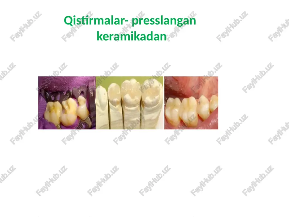 kali aluminosilikat va natriy aluminosilikat = dala shpati)deb nomlanadi.(k2o.al203.6si02) va (na2o.al203.6si02) = dala shpati) stomatologiyada sun'iy ravishda sintez qilingan dala shpatichinni ortopediktuzilmalarni ishlab chiqarish uchun birinchi keramik massalar. dala shpatidan foydalanish birinchi marta 1903 yilda charlz landning "tish fazosi" tibbiy nashrida porselen tojlarini tayyorlash jarayonini tasvirlagan asarlarida eslatib o'tilgan, ammo doktor porsanning katta mo'rtligi muammosiga duch kelgan. dalashpati keramikasi (shishakeramika) keyinchalik, chinni pishirish uchun vakuumli pechlar ixtiro qilinganligi sababli, baquvvat ko'rsatkichlari yaxshilandi bunday keramika quyidagilar uchun ishlatilgan: metall ramkalar (metallokeramika) qoplamasi (qoplamasi) olovga chidamli (refrakter gipsli modellar) shtamplar (refrakterda) yoki platina folga yordamida tayyorlangan chinni qoplamalar uchun bir qismli konstruksiya. shu bilan birga, chaynash paytida olingan siqish (siqish, bosim) yuklari shunga o'xshash restavratsiyalarda ko'plab chiplarni keltirib chiqardi.bu eng estetik va eng mo'rt hisoblanadi. foydalanish mumkinkichik nuqsonlar mavjud bo'lganda estetikani yaxshilash uchun old tishlar uchun. chinnini pishirish uchun vakuumli pech presskeramikadan konstruksiya yasash bosqichlari: 1. tish texniki mum yordamida gips modelda …