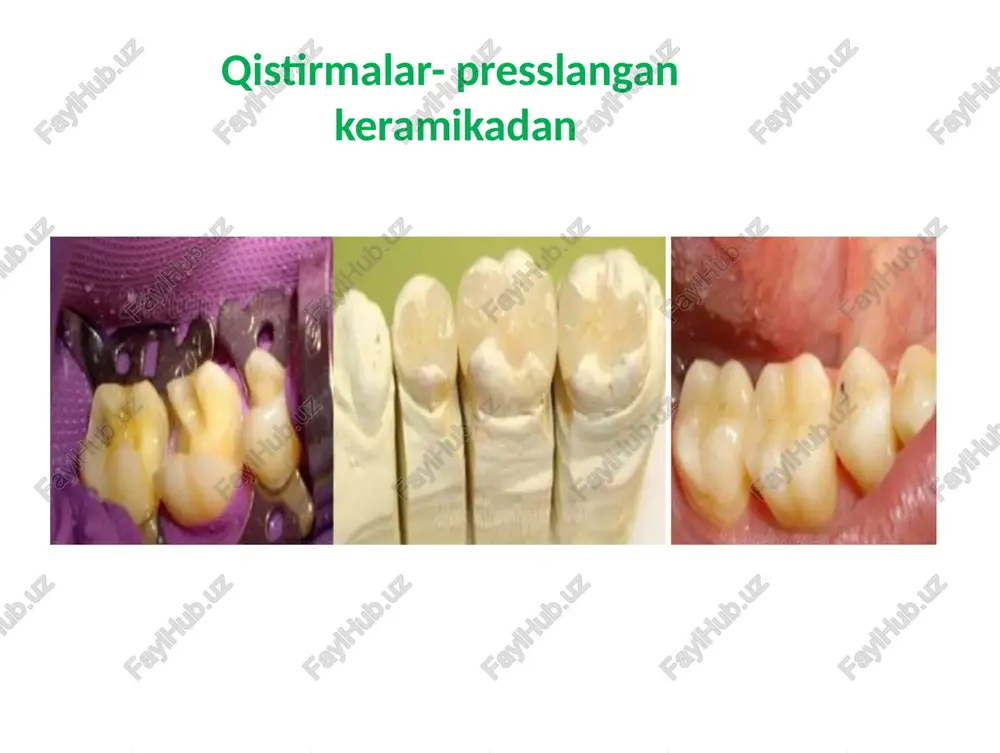 silikat va natriy aluminosilikat = dala shpati)deb nomlanadi.(k2o.al203.6si02) va (na2o.al203.6si02) = dala shpati) stomatologiyada sun'iy ravishda sintez qilingan dala shpatichinni ortopediktuzilmalarni ishlab chiqarish uchun birinchi keramik massalar. dala shpatidan foydalanish birinchi marta 1903 yilda charlz landning "tish fazosi" tibbiy nashrida porselen tojlarini tayyorlash jarayonini tasvirlagan asarlarida eslatib o'tilgan, ammo doktor porsanning katta mo'rtligi muammosiga duch kelgan. dalashpati keramikasi (shishakeramika) keyinchalik, chinni pishirish uchun vakuumli pechlar ixtiro qilinganligi sababli, baquvvat ko'rsatkichlari yaxshilandi bunday keramika quyidagilar uchun ishlatilgan: metall ramkalar (metallokeramika) qoplamasi (qoplamasi) olovga chidamli (refrakter gipsli modellar) shtamplar (refrakterda) yoki platina folga yordamida tayyorlangan chinni qoplamalar uchun bir qismli konstruksiya. shu bilan birga, chaynash paytida olingan siqish (siqish, bosim) yuklari shunga o'xshash restavratsiyalarda ko'plab chiplarni keltirib chiqardi.bu eng estetik va eng mo'rt hisoblanadi. foydalanish mumkinkichik nuqsonlar mavjud bo'lganda estetikani yaxshilash uchun old tishlar uchun. chinnini pishirish uchun vakuumli pech presskeramikadan konstruksiya yasash bosqichlari: 1. tish texniki mum yordamida gips modelda qistirma, …