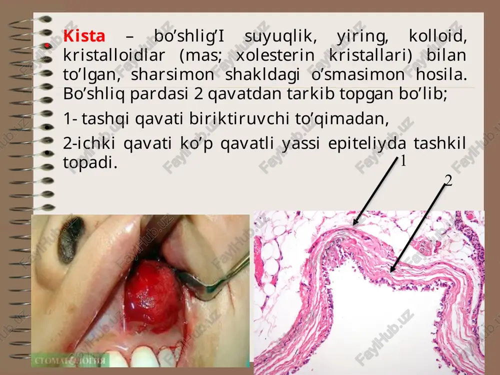 a nozologik shaklga tegishlidir). ko'pincha kistalar - tishlarni noto'g'ri da-volash oqibatida, shikastlanish o’chog’ida infektsiyaning rivojlanishi natijasida ham yuzaga kelishi mumkin (yiringli kista - abses ). ildiz (radikulyar) kista - bu eng ko’p uchraydigan kista bo’lib, tish ildizi cho’qqi qismida joylashgan yallig'lanishga aloqador hosila. asosan tuxumsimon shaklda bo’lib, bo’shlig’i suyuqlik (transudat) bilan to’lgan bo’ladi. surunkali periodontitdagi murakkab granulema-ga bog‘liq, xar qanday tish ildizi soxasida xosil bo‘lishi mumkin. yuqori jag‘da pastki jag‘ga nis-batan ikki marta ko‘p uchraydi, o‘lchamlari 0,5-3,0 smgacha bo’ladi. ichki yuzasi ko‘p qavatli yassi, muguzlanmaydi-gan epiteliy bilan qoplangan bo‘ladi. devoridagi fibroz to‘qimada limfotsitlar va plazmatik xujayralar uchraydi. burun-tanglay kanali kistasi - (nazo-palatinal kanal kistasi) – burun-tanglay na-yining degeneratsiyasi oqibatida yuzaga ke-luvchi noonkogen kista. kanallar odatda homiladorlik paytidayoq bitib ketib qoladi. obliteratsiyalangan nay epiteliysi kista shakl-lanishiga olib keladi. burun-lab kistasi - alveolyar o’siq bilan burun qanoti asosi ostida joylashuvchi, yuqori jag’ning noodontogen, chin kistasi. globulomaxillar kista – lateral kesuvchi tish va …