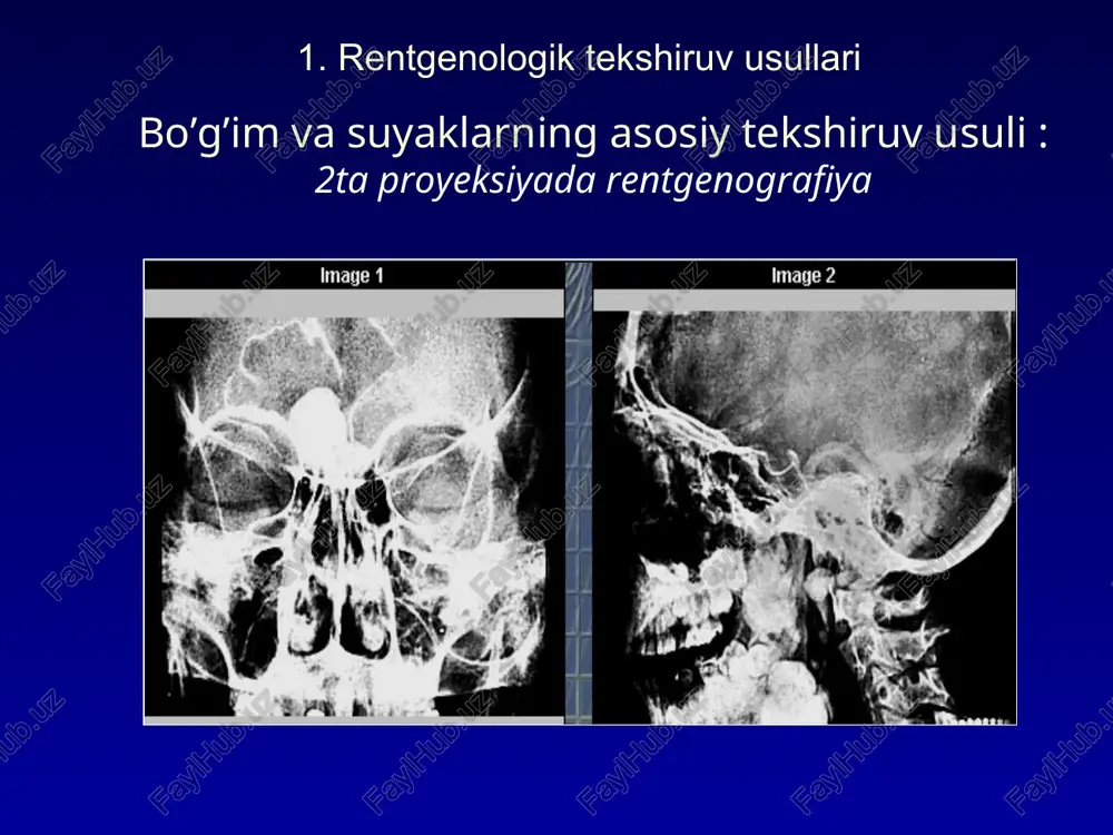 ng xiralashishi va xiralashishi rentgensemiotika b. suyak usti pardasi o’zgarishi - bir qavatli chiziqli periostit, - bir qatlamli intervalli periostit, - qatlamli (ko'p qatlamli) periostit, - baxromasimon periostit, - dantelli periostit, - igna shaklidagi (spikula shaklidagi) periostit, - nursimon periostit. rentgensemiotika periostitlar turli xilligi sxemasi: a- chiziqli intervalli b- bir qavatli c- ko’p qavatli bezaksimon d- baxromasimon d- ignasimon e-nursimon rentgensemiotika 3. suyak tuzilishidagi o'zgarishlar - sinish chizig'i - osteoporoz (notekis, mahalliy, mintaqaviy, diffuz, tizimli) - osteoskleroz (mahalliy, mintaqaviy, diffuz, tizimli) - suyakni yo'q qilish (yo'q qilish) - nonspesifik, o'ziga xos, o'sma, degenerativ-distrofik - osteonekroz - sekvestrlash - osteoliz rentgensemiotika suyak strukturasi a – norma , b – barmoq panja suyaklari osteoporozi b a rentgensemiotika suyak strukturasi o’zgarishi (sxemasi) a - destruksiya o’chg’ katta boldir suyagi proksimal metafizida b - osteonekroz joyi sonning epifizida va fokusda mavjudligi bilan halokat metafizdagi sekvestr tibiada rentgensemiotika 4. bo’g’imlar o'zgarishlar - artikulyar yuzalarning qisman …