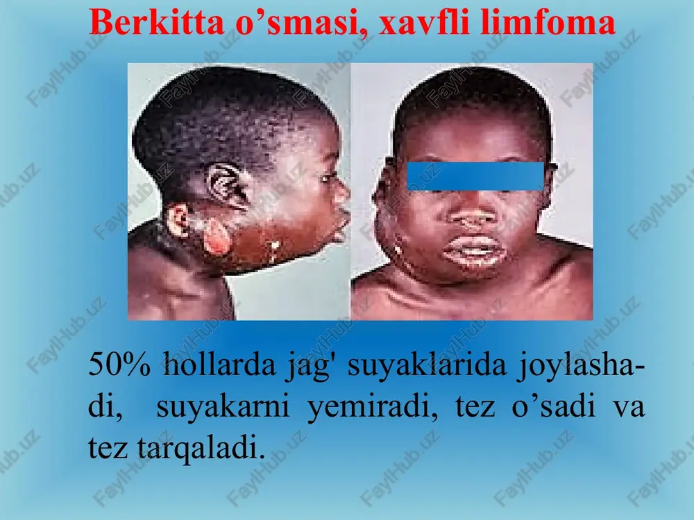 ogen epiteliy xujayralari bez chiqaruv naylariga o'xshash hosilalar hosil qiladi. birlamchi suyak ichi karsinomasi. epidermal rak tuzilishiga ega, tish tirqishi soxasidagi odontogen (malasse orolchalari) yoki dizontogenetik odontogen epiteliydan rivojlanuvchi, tez va suyaklarni emirib o’sish xususiyatiga ega xavfli o’sma. № xavfsiz odontogen mezenximal o’smalar. 1 dentinoma 2 odontogen miksoma 3 sementoma - xavfsiz sementoblastoma; - sementlovchi fibroma; - sementli periapical displaziya; - gigant sementoma; 4 odontoma - murakkab; - shakllangan. dentinoma; kam uchraydigan, sekin va ekspansiv o’suvchi, aso-san bolalarda, pastki jag’, molyarlar soxasida yoki o’rnida uchrovchi, rentgenologig – chegaralangan soxada suyak to’qi-masi zichligining kamayishi bilan xarakterlanuvchi, kapsula bilan o’raglan tugun shaklidagi, kesmasida kulrang-oqish tusdagi hosila. gistologik – odontogen epiteliy tutamlari, shakllanmagan biriktiruvchi to’qima va displastik dentindan iborat xavfsiz o’sma. dentinoma odontogen miksoma odontogen miksoma; deyarli hech qachon kapsulaga ega bo’lmaydi, mahalliy destruktiv o'sish bilan tavsiflanadi, olib tashlangandan keyin tez-tez qaytalanadi. boshqa lokalizatsiya miksomasidan farqli o'laroq, u faol bo'lmagan odontogen epiteliya iplarini …