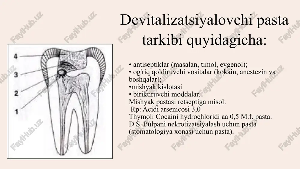 iga kiritilgan antiseptik qatlamlari orqali, ortiqcha bosimsiz, vaqti-vaqti bilan harakatlar bilan (pulpa kuyishini oldini olish uchun) tishning toj bo'shlig'i ustidagi tonozni eng yupqalashgan joyda (ko'pincha pulpa shoxi sohasida) oching. keyin steril yoriq bor bilan tonoz butunlay kesiladi. 4. yallig'langan toj pulpasini amputatsiya qilish (qisman olib tashlash). ehtiyotkorlik bilan o'tkir ekskavator yordamida toj pulpasining amputatsiya paytida olinmagan qismi olib tashlanadi. ildiz kanallarining og'izlarini kengaytirish. ildiz kanallarining og'izlari kichik o'lchamdagi steril sharsimon bor bilan ehtiyotkorlik bilan huni shaklida kengayadi va ildiz pulpasining bir qismi kichik o'tkir ekskavator bilan chiqariladi. ildiz kanallariga kirish joylari ustidagi dentin qoldiqlari va soyabonlarni olib tashlash kerak, ularning ostida nekrotik pulpa qoldiqlari qolishi mumkin. bundan tashqari, kanoplar dorivor pastaning ildiz pulpa kultiga yopishishini oldini oladi. 6. qon ketishini to'xtatish. pulpani shikastlanishiga yo'l qo'ymaslik uchun ehtiyot choralariga rioya qilmasdan amputatsiya qilish sezilarli qon ketishiga olib kelishi mumkin, bu ildiz pulpasining o'limiga olib kelishi va 3% vodorod peroksid eritmasi bilan …