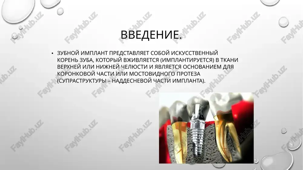 niya, sulfat kaltsiya, biosteklo i materiali na osnove nekotorix visokomolekulyarnix polimerov i t.p. xarakternoy osobennostyu etix materialov yavlyaetsya polnaya libo chastichnaya ix degradatsiya (rassasivanie) so vremenem i zameshenie normalnoy kostnoy tkanyu. titan: samim nadejnim i bezopasnim materialom dlya implantatsii yavlyaetsya titan i splavi na ego osnove. titan obladaet prekrasnimi mexanicheskimi svoystvami i otlichnoy biosovmestimostyu. udivitelno legkiy, prochniy, s xoroshey teploizolyatsiey titan – eto biologicheski inertniy metall. ne vizivaet allergii, imeet rezistentnost (ustoychivost) k korrozii, ustoychiv k vozdeystviyu bolshinstva organicheskix soedineniy, poetomu ne proisxodit ego ottorjeniya, prevrashaya titan v idealniy analog utrachennogo zubnogo kornya. dolgovechnost implantata vo mnogom zavisit ot mikro- i makrodizayna implantata. mikrodizayn – eto osobennosti poverxnosti implantata. mikroporistaya poverxnost implantata sposobstvuet bolee bistroy i polnotsennoy osteointegratsii (prijivleniyu). poverxnost titana spetsialno obrabativaetsya: ispolzuetsya plazmennoe napilenie titana ili pokritie poverxnosti mikrochastitsami oksida titana, kotorie obrazuyut melchayshie nerovnosti i sheroxovatosti, uluchshayushie fiksatsiyu implantata v chelyustnoy kosti. makrodizayn – eto osobennost stroenie …