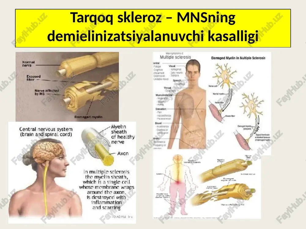 igoklonal antitanachalarning paydo bo‘lishi. bitta qo‘zg‘alish+bitta klinik simptom+bitta mrt o‘choq+likvorda igg miqdorining oshishi va oligoklonal antitanachalarning paydo bo‘lishi b) tarqoq skleroz tashxisini taxminan tasdiqlovchi belgilar: ikkita qo‘zg‘alish+bitta klinik simptom. bitta qo‘zg‘alish+ikkita klinik simptom. bitta qo‘zg‘alish+bitta klinik simptom+bitta mrt o‘choq. v) tarqoq skleroz tashxisi bo‘lishi mumkin: ikkita qo‘zg‘alish+likvorda igg miqdori oshishi va oligoklonal antitanachalar paydo bo‘lishi. faqat ikkita qo‘zg‘alish*. immunoglobulin (lgg) nima vazifani bajaradi va qachon oshadi? immunoglobulin g (igg) - barcha immunoglobulinlarning deyarli 80 % ini tashkil qiladi. igg sinfiga mansub antitanachalar infeksion kasalliklarda doimiy gumoral immunitetni ta'minlaydi, ya'ni organizmga tushgan begona unsurlarga nisbatan immun javob beruvchi oqsildir. igg – viruslar, bakteriyalar, toksinlarga qarshi antitanachadir. shuning uchun ham surunkali infeksiyalarda, ayniqsa, autoimmun kasalliklarda igg miqdori oshadi. qonda igg 6,5-16 g/l. tarqoq sklerozda bemorlarni davolash tartibi kasallik qo‘zg‘alishining oldini olish uchun: rebif, kopakson, azatiopirin kasallik qo‘zg‘alganda: kortikosteroidlar, plazmaferez metabolik terapiya: aminokislotalar, vitaminlar simptomatik terapiya: midokalm, sirdalud, karbamazepin, klonazepam, sibazon, fevarin interferonlar …