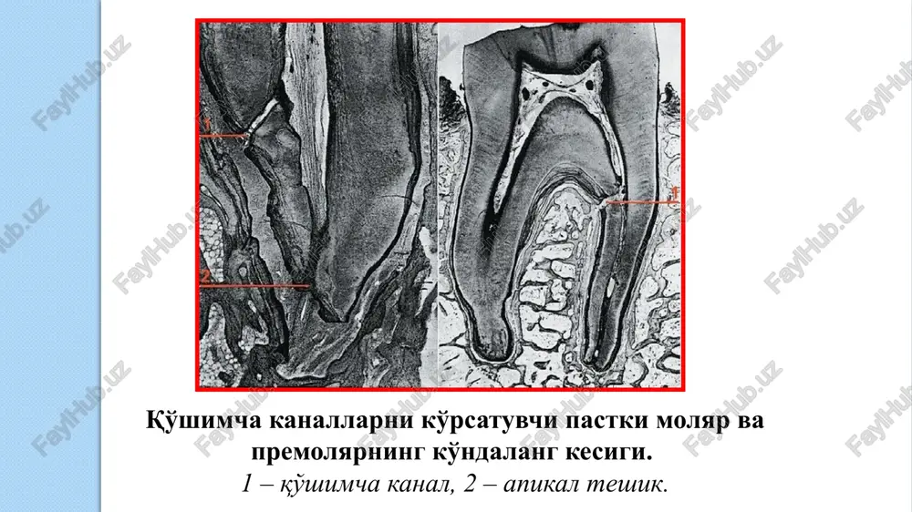 orligi, ammo, yallig'lanish vaqtida ularning sonini keskin ortishini isbotlashgan. limfotsitlar asosan pulpaning pereferik sohalarida uchraydi. ular katta yadroli oval xujayralar bo'lib, turli kattalikdagi xromatin to'plamlaridan iborat. tsitoplazmasida mitoxondriya, ribosoma, lizosomalar bo'ladi. limfotsitlar himoya vazifasini bajaradi. ildiz pulpasi – periodont va umumiy qon va nerv tomir tizimi bilan bog'langan bo'lib, toj pulpasidan farqli ravishda tolalarga boy bo'ladi. xujayra elementlari kam. toj pulpasi – xujayra elementlariga, qon tomir tutamlari va nerv chigallariga boy bo'ladi. pulpaning tolalari: kollagen tolalar – toj pulpada turli orientatsiyada bo'lib, to'r xosil qiladi, toj pulpasining pereferik sohasida zich tutamlar ko'rinishida bo'ladi. ildiz pulpasida uzunasiga, zich tutamlar hosil qiladi. retikulyar tolalar – butun pulpa bo'ylar to'r xosil qilib joylashadi. dentin xosil bo'lishida, bular qalinlashadi va pereferik pulpada soni ortib boradi. oksitalan tolalar – asosan pulpani pereferik sohasida ko'p bo'lib, qon tomirlar bilan birga joylashadi. elastik tolalar – faqat tomir devorlari oldida uchrashi mumkin. pulpaning asosiy moddasi: siyrak tolali biriktiruvchi …