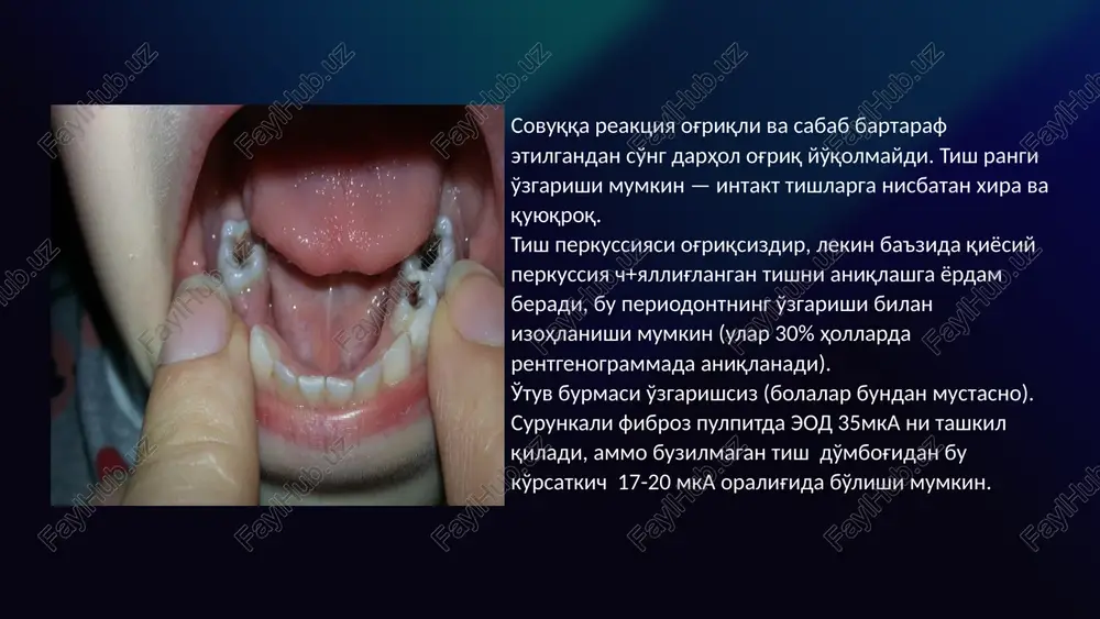 olipa, kotoriy obrazuetsya pri razrastanii desnevogo sosochka, zapolnyaya karioznuyu polost, a takje ot vrastaniya periodontalnix tkaney pri perforatsii dna pulpovoy polosti, dopushennoy vrachom pri lechenii zuba v proshlom. surunkali gangrenoz pulpit. bu tishning ochiq va yopiq bo'shlig'ida ham paydo bo'lishi mumkin; ikkinchi holda, "o'z-o'zidan" og'riq paydo bo'lishi mumkin, ammo bu simptom beqaror. issiqdan va oziq-ovqat eyilganda lvqat qoldiqlari tushganda og'riq paydo bo'lishi mumkin. tekshiruvda, ko'pincha zondlashga javob reaktsiyasi mavjud emas, bu toj pulpasining o'limini ko'rsatadi, ammo chuqur zondlash og'riqqa sabab bo'ladi. toj pulpasining nekrozi bo'lsa, u yoqimsiz hidli strukturasiz massa sifatida namoyon bo'ladi, pulpaning elektr qo'zg'aluvchanligi esa sezilarli darajada kamayadi (40-60.). tish bo'shlig'i yopiq bo'lsa, issiqqa nisbatan sinama og'riqni keltirib chiqarishi mumkin, perkussiya ba'zida zaif ijobiy reaktsiya beradi. radiologik jihatdan periodontal yoriqning kengayishi ko'pincha aniqlanadi, ba'zida suyak to'qimalarining ingichkalashi bilan. 9 xronicheskiy gangrenozniy pulpit (pulpitis chronica gangraenosa) razvivaetsya iz gnoynogo ili xronicheskogo fibroznogo pulpita pri popadanii v pulpu gnilostnix bakteriy. …