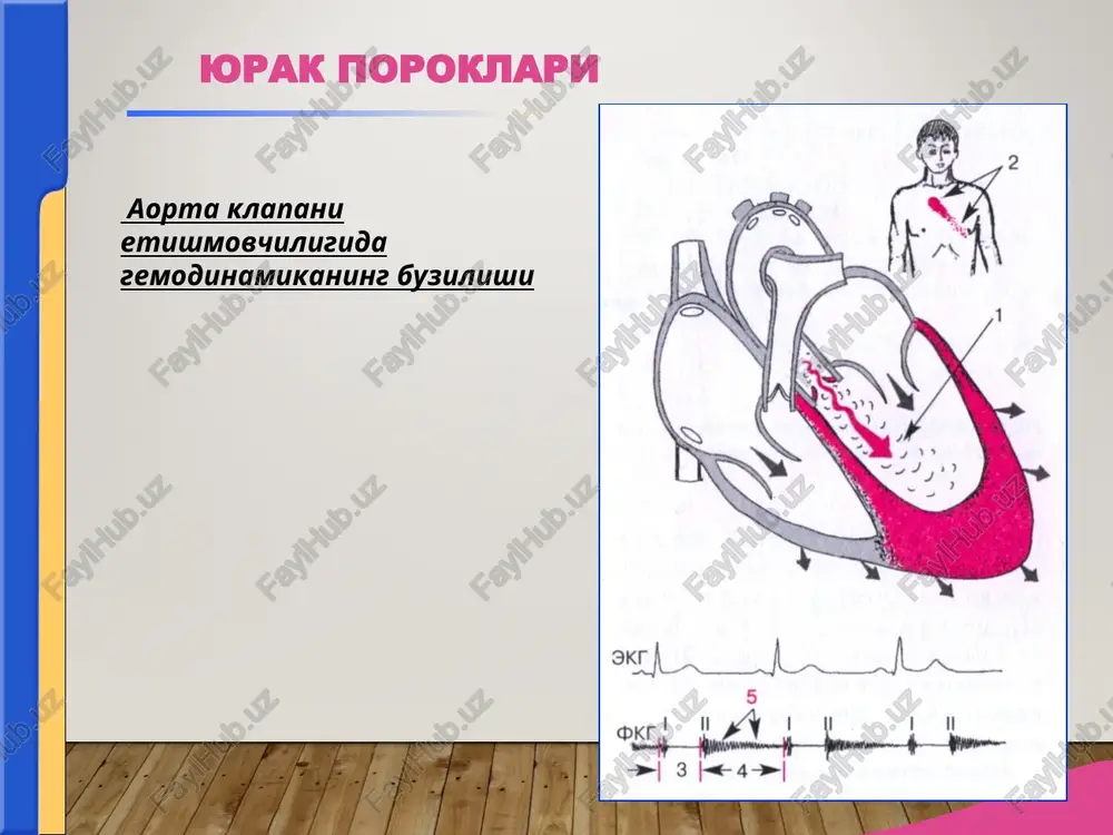 natijasida chap qorincha hajmining kengayishi kuzatiladi. chap qorincha dilyatatsiyasining gipertrofiyasi mavjudligi bilan bog'liq holda yurak uchining yumaloqlashishi aniqlanadi. porok etiologiyasi sifilis bilan bog'liq bo'lgan holda aortaning pastki qismi kengaygan bo'ladi. aortal teshik stenozi (ats) yurak chap qorinchasi qisqarganda aortaga qon oqishiga qarshiliklar yuzaga keladigan xollardagi porok (aortal klapan yoriqlarining bitishi yoki aorta ogzidagi chandiqlar qisqarishi) sabablari: -revmatik endokardit -bakterial endokardit -ateroskleroz -tug'ma poroklar yurak poroklari aorta teshigi stenozida gemodinamikaning buzilishi aorta teshigi stenozi simptomatologiya si shikoyatlar: -stenokardiya tipida yurak soxasidagi og'riqlar. -bosh aylanishlar, -bosh og'riqlar, -bexushlikka moyillik. ko'zdan kechirish: -teri rangining okarishi -yurak uchi turtkisini chap tomonga, ba'zan pastga ko'chgan kuchli silkinishda namoen bulishi paypaslash(palpatsiya) -yurak uchi turtkisini chap tomonga, ba'zan pastga ko'chgan kuchli silkinishi. - aorta ustida sistolik «mushuk xirillashi» yuzaga keladi. yurak poroklari tukillatish (perkussiya) tukillatishda yurakning bo'g'iq ovozi chap qorinchaning kengayishi hisobiga chap tomonga siljiganligi aniqlanadi. yurak beli yaxshi ifodalangan aortal konfiguratsiya vujudga keladi. yurak poroklari eshitish …