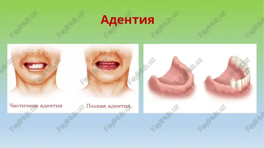ilangan nuqson sinfini o'zgartirishi mumkin. 2. agar uchinchi molyar etishmayotgan bo'lsa, u almashtirilmasa, tasnifda hisobga olinmaydi. 3. mavjud uchinchi molyar tayanch tish sifatida ishlatilishi kerak bo'lsa, tasnifda hisobga olinishi kerak. 4. ikkinchi molyar etishmayotgan bo'lsa, agar u almashtirilmasa, tasnifda hisobga olinmaydi. nuqsonning sinfi eng distal joylashgan tishsiz sohaga qarab aniqlanadi (ya'ni jag'da bir nechta nuqson mavjud bo'lsa, sinf sifatida raqamlanishi bo'yicha kichikroq bo'lgan klsiy qabul qilinadi). 6. qo'shimcha nuqsonlar kichik sinflar sifatida qaraladi va ularning soni bilan aniqlanadi. 7. qo'shimcha nuqsonlarning o'lchami ko'rib chiqilmaydi; faqat soni hisobga olinadi, kichik sinf raqami bilan belgilanadi. 8. iv sinfda kichik sinflar yo'q. adentiya oqibatlari • funktsiyalarning buzilishi: chaynash, nutq, yutish. • alveolyar o'simtaga tushadigan yukning kamayishi → uning atrofiyasi. • bolalarda jag'larning o'sishi va shakllanishi buzilishi. • tish qatorlari deformatsiyasi, okklyuziyaning o'zgarishi. • estetik nuqson bilan bog'liq psixoemotsional buzilishlar. adentiya tish-jag' tizimida buzilishlarni keltirib chiqaradi va quyidagi o'zgarishlarga olib keladi: suyak to'qimasi atrofiyasi …