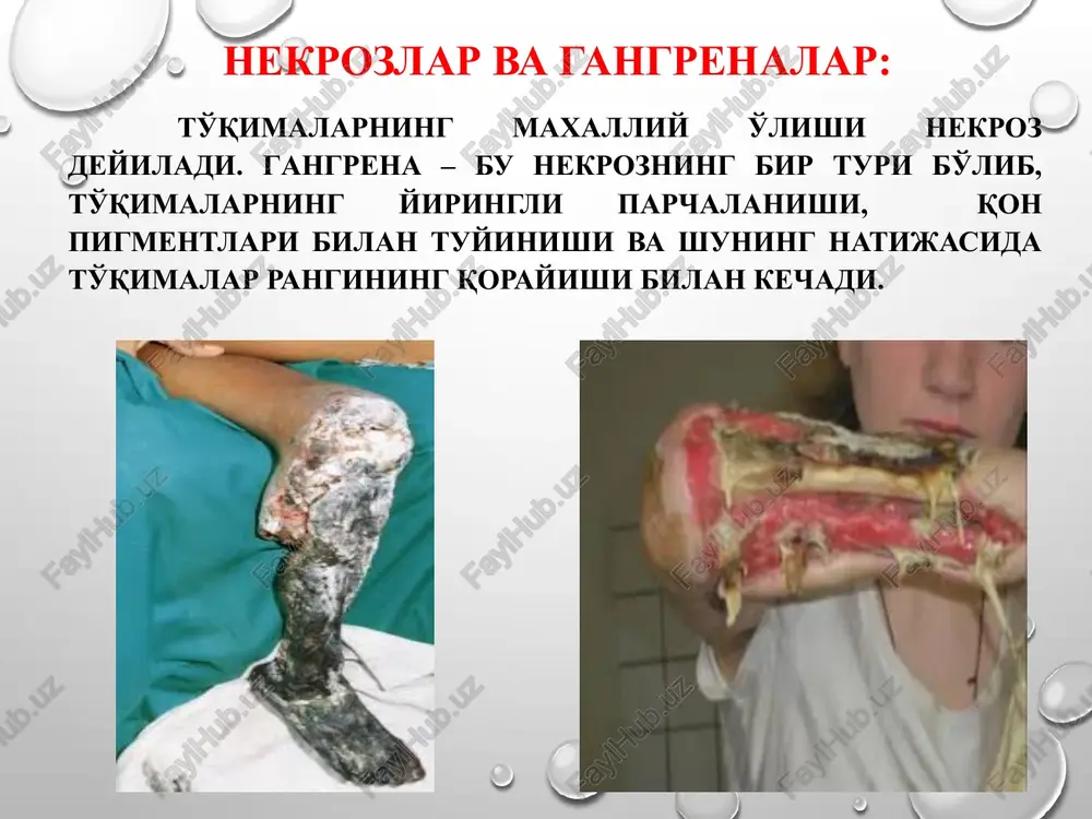 abet natijasida rivojlanadi. klinik manzarasining xususiyatlariga ko'ra spetsifik gangrenalarning tarkibiga yana quyidagilar ham kiritiladi: 1. aterosklerotik yoki keksalik gangrenasi. 2. o'spirinlik (yuvenil) yoki spontan gangrenasi. 3. simmetrik gangrena. quruq gangrena quruq gangrena ko'pincha oyoq qo'llarda kuzatiladi. u asosan qon aylanishi buzilishi sekin asta rivojlanib borayotgan ojizlangan, ayniqsa oyoq yoki qo'llarga tashqi muxitning noqulay omillari ta'sir qilayotgan bemorlarda kuzatiladi. quruq gangrenada to'qimalar suvsizlanadi, quriydi va mumiyolanadi, dag'allashib bujmayadi, jigarrang yoki ko'kimtir qora rangga kiradi. jarayon chegaralangan bo'ladi va zo'raymaydi. gistologik nuqtai nazardan to'qimalarda xujayra yadrolarning parchalanishi bilan, eritrotsitlar va leykotsitlarning parchalanishi, plazma oqsillarining ivishi ko'rinishida koagulyatsion nekroz rivojlanadi. klinik manzarasi: kasallikning boshlang'ich bosqichlarida qo'l oyoqlarning shikastlangan joyidan distal kismlarida kuchli ishemik ogriqlar kuzatiladi. qo'l oyoqlar oqish bulib, soviydi, terisi marmar rangga kira boshlaydi. yuzaki va chuqur sezgi yo'qolib, oyoq qo'llarning faoliyati buziladi. periferik arteriyalarda tomir urishi aniqlanmaydi. agarda magistral tomirlarning shikastlanishi bilan bir vaqtning o'zida kollateral tomirlarning spazmi kuzatilsa gangrena kattagina …