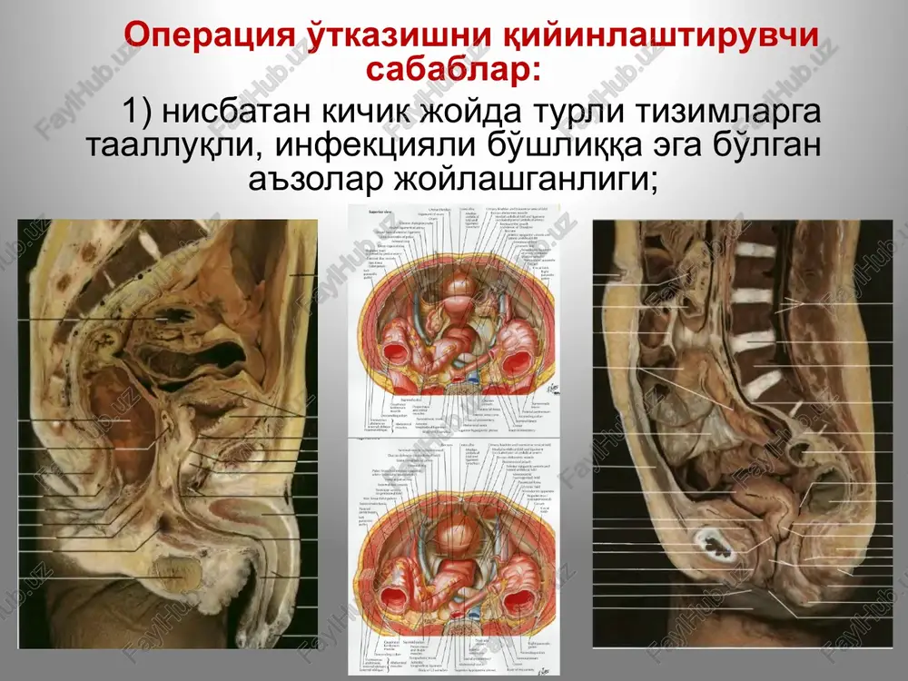da a'zo atrofidagi tomir va nerv chigallari, limfa tomirlari joylashadi. qorinparda osti bo'shlig'i (savum relvis subperitoneale) qorinparda bilan tos diafragmasi fastsiyasi orasidagi g'ovak kletchatkada tomir va nerv chigallari tos flegmonalarida kuchli og'riqlarga sababchi bo'ladi. qovuq oldi kletchatka bo'shlig'i orqada qovuq old devori, oldinda – qov suyaklari va qorin old devori bilan chegaralanadi, yuqorida kindikkacha tarqaladi. bu bo'shliq son kanali kletchatkasi bilan, tomir lakunasi orqali sonning old-ichki qismi bilan tutashgan. bu erdagi yiring ko'ndalang fastsiyani eritib, kindik orqali tashqariga chiqishi mumkin. bo'shliqni qov ustidan oq chiziq bo'yicha yoki to'g'ri muskullarning biri orqali (reyn bo'yicha) ochish mumkin. yiring chuqurroqda bo'lganida oraliq sohasi yoki yopqich membranasi orqali ochish - buyalskiy-mak-uorter bo'yicha. parametritlarni drenajlashning ikki usuli mavjud: qorin old devori (chov burmasiga parallel kesish) orqali, qin gumbazi orqali (bunda yon tomondagi siydik nayi va bachadon tomirlari shikastlanishi mumkin). tos a'zolari innervatsiyasi simpatik: - aorta chigali - yonbosh arterial chigallar - pastki tutqich arteriya chigali …