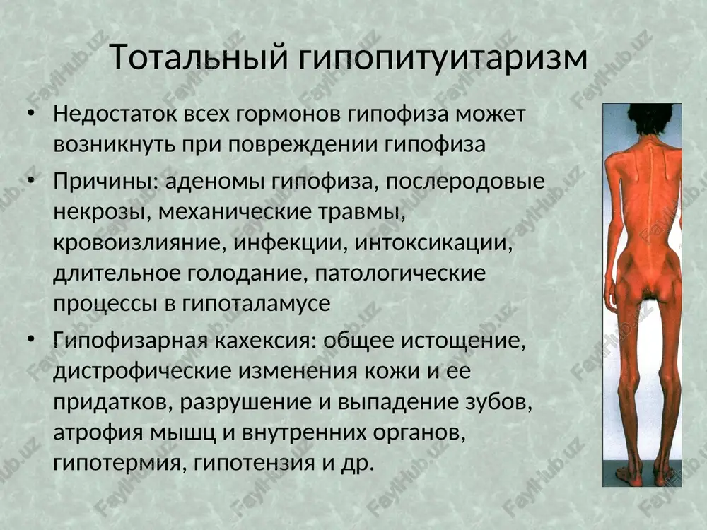 sledstvennost predraspolagayushie faktori: virusnie zabolevaniya psixicheskie travmi, stressi insolyatsiya patogenez klinika tsns: utomlyaemost, povishennaya razdrajitelnost, plaksivost, ploxoy son, potlivost, subfebrilitet, tremor paltsev ruk, vek, yazika, giperkinezi sss: serdtsebienie, taxikardiya, povishenie sistolicheskogo i snijenie diastolicheskogo ad, toni gromkie, sistolicheskiy shum na verxushke jkt: povishenie appetita, jajda, ponosi, poxudanie klinika glaznie simptomi: ekzoftalm, redkoe miganie, povishenniy blesk glaz, usilenie pigmentatsii vek uvelichenie shitovidnoy jelezi, pri palpatsii – pulsatsiya, pri auskultatsii - shum endemicheskiy zob zabolevanie, proyavlyayusheesya uvelicheniem shitovidnoy jelezi bez yavnix klinicheskix priznakov narusheniya eyo funktsii etiologiya nedostatok yoda v vode, pochve, produktax nasledstvennaya predraspolojennost priyom nekotorix lekarstv: salbutamol, astmopen, pask, sulfanilamidi klinika vozmojni jalobi na razdrajitelnost, ploxoy son, snijenie uspevaemosti uvelichenie shitovidnoy jelezi razlichnoy virajennosti: ot i do v stepeni oslojneniya tireoiditi malignizatsiya diagnostika zabolevaniy shitovidnoy jelezi skrining novorojdyonnix: pri vrojdyonnom gipotireoze uzi shitovidnoy jelezi analiz krovi na uroven ttg, tiroksina i triyodtironina biopsiya uzlov semiotika porajeniya parashitovidnix jelez (pshj) gipoparatireoz …