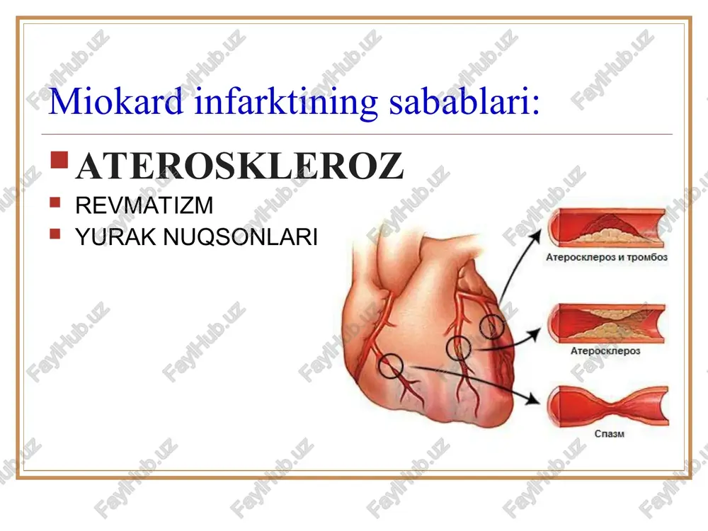 tning og'riqsiz shakli uchraydi. bunday bemorlarda kasallik yakuni yomon bo'lib, bosh miyada qon aylanishining buzilishi, qayta takrorlanuvchi infarkt bo'lishi mumkin. yurak etishmovchiligi va kardiogen shok faqat birinchi kuni emas, keyingi kunlari xam paydo bo'lishi bunday paytda buyrak etishmovchiligi bo'lganida ishemik insultga olib kelishi mumkin. kasallik asoratlaridan yurak ritmining buzilishi, miokard yorilishi va chap qorincha bilan o'ng qorincha orasidagi to'siq yorilishi, tromboembolik asoratlar, yurak anevrizmasi kasallik oqibatini yomonlashtiradi. xamshiralik yordamini tashkil etish - og'riq xurujini to'xtatish kerak - teri ostiga 1 – 2 ml morfin va 0,5 ml atropin sulfat yuboriladi - aqb ko'tarish maqsadida kofein, mezaton, kardiamin qilinadi - yurak toj tomirlarida tromblar xosil bo'lishini to'xtatish maqsadida geparin 2 – 3 kun davomida xar 6 soatda 5000-10000tbda m\o yuboriladi - bemor funktsional karovatga yotqizilib, axvoli muntazam kuzatilishi kk - yotoq yaralar xosil bo'lmasligi uchun teri gigienasiga rioya qilinishi lozim - parxezga rioya qilinadi - qatiy yotoq rejimi 2 sutka davomida …