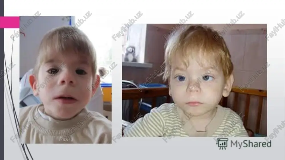 normalliklarga birinchi bo'lib tashxis qo'yadigan mutaxassislar pediatrlar , bolalar stomatologlari va ortoped-travmatologlardir. tashqi tekshiruv ma'lumotlarini tasdiqlash, shuningdek, ichki organlarning birgalikdagi patologiyalarini aniqlash uchun bemorlarga buyurilishi mumkin: radiografiya . aniqlangan anomaliyalarga qarab, yuz skeleti , bosh suyagi, jag'lar, oyoq-qo'l suyaklari, umurtqa pog'onasi va ko'krak qafasining rentgenogrammasi olinadi. tadqiqotning maqsadi nafaqat tizimli, balki funktsional buzilishlarni ham aniqlashdir, shuning uchun rentgenografiya ko'pincha namunalar bilan to'ldiriladi. tomografiya . skelet anomaliyalarining zo'ravonligini aniqlash uchun kompyuter rentgen tomografiyasi katta informatsion ahamiyatga ega. agar kerak bo'lsa, mri yumshoq to'qimalar va ichki organlarning holatini baholash uchun ishlatiladi. sonografiya . homilador ayollarni ultratovush tekshiruvi paytida disembriyogenezning ba'zi stigmalarini sezish mumkin . genetik kasalliklarga shubha qilish invaziv prenatal tashxis uchun sababdir . tug'ilgandan so'ng, asosiy nuqsonlarni aniqlash uchun buyrak ultratovush va ekokardiyografi o'tkaziladi . laboratoriya diagnostikasi . karyotiplash va molekulyar genetik tadqiqotlar ma'lum xromosoma yoki gen kasalliklarini ko'rsatadigan disembriogenezning bir nechta stigmatlari uchun ko'rsatiladi. tug'ruqxonada barcha yangi tug'ilgan chaqaloqlar 5 …