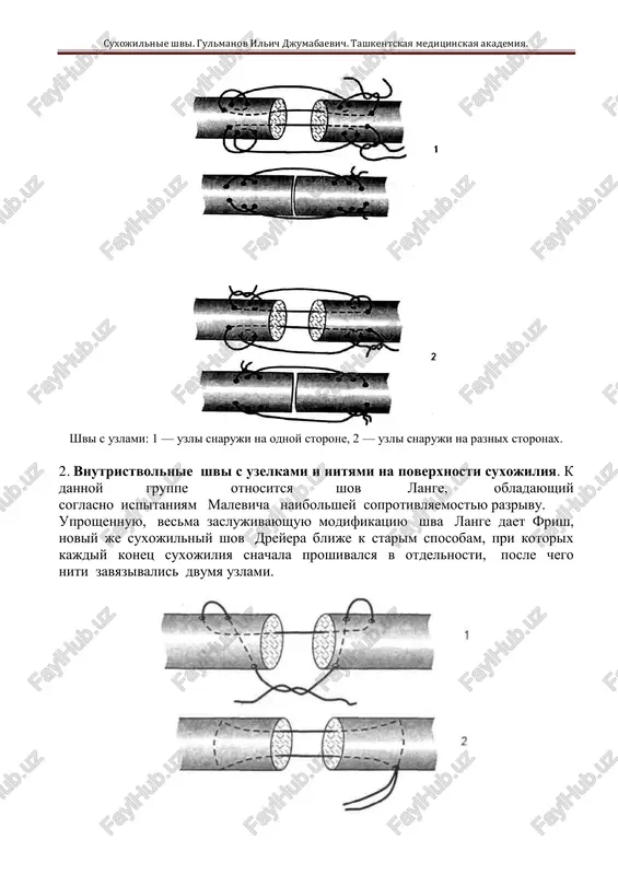 rniy shov rottera. 2. ligaturnie shvi (ispolzuemie v kachestve opori). suxojilnie shvi. gulmanov ilich djumabaevich. tashkentskaya meditsinskaya akademiya. ligaturnie shvi, ispolzuemie v kachestve opori. 3. p-obraznie shvi (s pryamim xodom nitey, odnostejkovie, mnogostejkovie). p-obrazniy shov lange s pryamim xodom niti: 1 — mnogostejkoviy, 2 — prostoy s provedeniem niti na poverxnosti suxojiliya. 3— prostoy s vnutristvolnim provedeniem niti. suxojilnie shvi. gulmanov ilich djumabaevich. tashkentskaya meditsinskaya akademiya. 4. krestoobraznie shvi (s odnokratnim i mnogokratnim perekreshivaniem nitey). varianti shvov s krestoobraznim xodom niti: 1 — shov bloxa, 2 — shov masona. 5. petlevidnie (s malim kolichestvom petel i s mnogochislennimi petlyami). petlevidniy shov: uproshenniy shov rozova. suxojilnie shvi. gulmanov ilich djumabaevich. tashkentskaya meditsinskaya akademiya. petlevidnie shvi: 1,2 — shov vilmsa. petlevidnie shvi. 3 — shov kazakova, 4 — shov kazakova-rozova. shovniy material dlya soedineniya kontsov suxojiliy doljen udovletvoryat sleduyushim trebovaniyam: — bit tonkim; — otlichatsya povishennoy prochnostyu; — ne vizivat vospalitelnoy reaktsii …