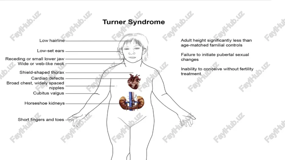 shershevskiy-turner syndrome - Page 3