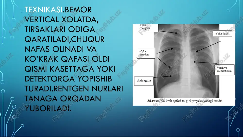 ganligi uchun(serroz, diafragmal churra). chap o’pkada total qorayish. ko’ks oralig’i a’zolari sog’lom tomonga siljigan. chap o’pkada suptotal qorayish. ko’ks oralig’i a’zolari sog’lom tomonga siljigan. o’n o’pka yuqori bo’lagida subtotal qorayish.siljish kuzatilmagan. • chegaralangan qorayish – bu o‘pka rentgenografiyasida yoki kompyuter tomografiyasida ko‘rinadigan, aniq konturlarga ega qoraygan (zulmatlashgan) soha bo‘lib, u turli xil patologik jarayonlarni ko‘rsatishi mumkin. bu holat o‘pkaning bir qismi havo bilan to‘lmaganida, yallig‘lanish, o‘sma yoki suyuqlik to‘planishida yuzaga keladi. • chegaralangan qorayish sabablari • infeksion kasalliklar • pnevmoniya (o‘pka yallig‘lanishi) – bakterial, virusli yoki zamburug‘li infektsiya natijasida o‘pka to‘qimalari havo bilan to‘lish o‘rniga yallig‘lanish suyuqligi bilan to‘ladi. • tuberkulyoz – ayniqsa, infiltrativ yoki kavernoz shakllarida o‘pkaning muayyan qismi qoraygan bo‘lishi mumkin. • o‘smalar (yaxshi yoki yomon xulqli) • o‘pka saratoni – chegaralangan, notekis yoki aniq konturlarga ega bo‘lishi ki • o‘pka atelektazi (havo yo‘qligi sababli o‘pkaning qisqarishi) • bronxlar tiqilib qolishi (shilliq, o‘sma yoki begona jism tufayli) natijasida …