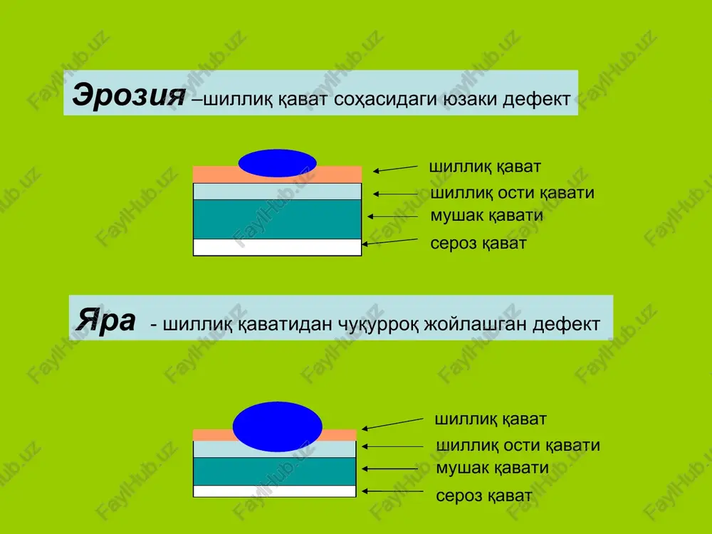 i o'tkir appenditsitdagi og'riqlar tarqalishiga o'xshaydi (og'riqlar epigastral sohadan o'ng yonbosh sohaga kuchishi - koxer-volkovich simptomi) diafragma ostida “erkin” gazning to'planishi (spijarskiy simptomi) “erkin” gaz obzor r - grafiya “erkin” gaz 12 b\i kuyi kismi orka devori perforatsiyasi perforatsiyani bu turi juda kam uchraydi. 12 b\i suyukligi korin bushligiga emas balki korin parda orti yog kletchatkasiga kuyiladi. klinik kechishida epigastral soxasida kuchli va keskin ogrik paydo bulib ogrik belga tarkaladi. vakt utishi bilan ogrik kamayib borib, 2 – sutkada korin parda orti flegmonasi rivojlanadi. bunda bemorda tana xarorati kutariladi, x-xii kukrak umurtka pogonasi ung tomonida shishli xosila aniklanadi.va shu soxa palpatsiya kilinganda krepitatsiya seziladi. rentgan tekshiruvida esa korin parda orti soxasida gaz aniklanadi. me'da yarasini kichik charvi varaklari orasiga teshilishi. pri perforatsii yazvi mejdu listkami malogo salnika klinicheskaya simptomatika razvivaetsya medlenno, boli dostatochno intensivnie, poyavlyaetsya klinika formiruyushegosya abstsessa malogo salnika - snova usilivaetsya lokalnaya bol, palpiruetsya ogranichenniy vospalitelniy infiltrat (v …