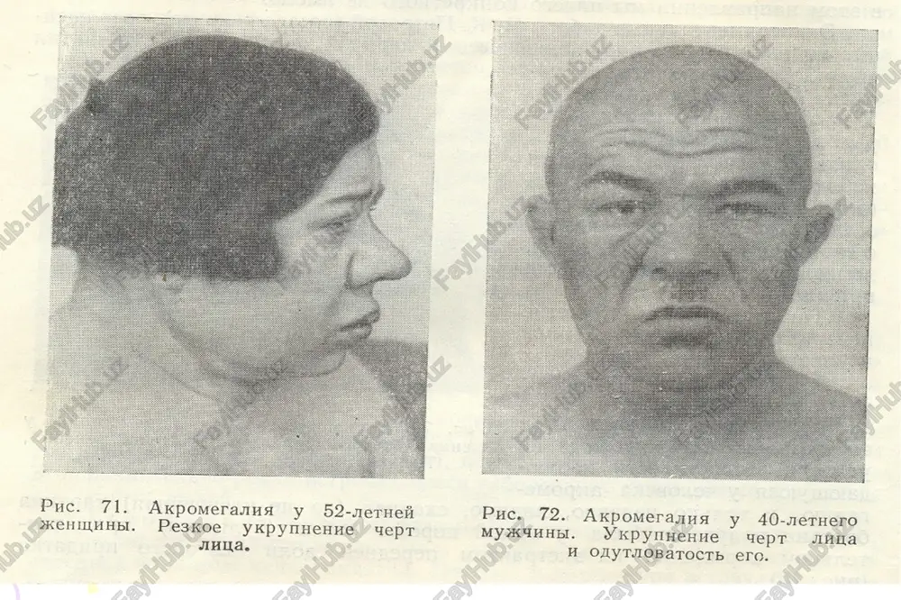 akromegaliya - Page 3