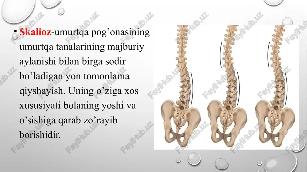 yaqqol ko’rinadigan deformatsiya va katta bukurlik. iv darajali skolioz-umurtqa pog’onasi ko’krak qismi kifoskaliozi, yaqqol ko’rinuvchi qovurg’a bukriligi, chanoq deformatsiyasi, qiyshayish burchagi 41-90 skaliozning umurtqa pog’onasini egilishiga ko’ra darajalari tashxislash 1. umurtqa pog’onasi qiyshayish burchagini aniqlash 2. deformatsiya barqarorligini aniqlash 3. chanoq qiyshiqliklari bor yoki yo’qligini aniqlash 4. umurtqa pog`onasining ultratovush tekshiruvi; 5. umurtqa pog'onasining rentgenologik tekshiruvi; 6. umurtqa pog'onasining magnit-rezonans tomografiyasi; 7. umurtqa pog'onasining kompyuter tomografiyasi; 8. umurtqalararo disklarning kontrastli diskografiyasi; 9. umurtqa pog`onasining elektrospondilografiyasi. qiyshayish burchagi darajasini aniqlash kobb usuli bu usuk qiyshayish yoyi so’ngi umurtqalari tomonidan tashkil topgan burchakni aniqlashga asoslangan. to’g’ri proyeksiyadagi rentgen suratidan neytral umurtqalar asosidan umurtqalararo bo’shliqga parallel qilib ikkita chiziq tortiladi. o’tkazilgan chiziqlarga perpendikulyar chiziq tortiladi. perpendiyulyarlar orasida hosil bo’lgan burchak umurtqa pog’onasi qiyshayish darajasini tashkil qiladi. deformatsiya darajasini aniqlash bolalarda deformatsiya darajasi: tik turgan o’tirgan yotgan holda aniqlash yangi tug’ilgan chaqaloqlarda mo’ljal suyaklari orqali tekshiriladi. umurtqalarning qirrali o’simtalari, kurakning pastki burchagi, kurakning yo’qori …