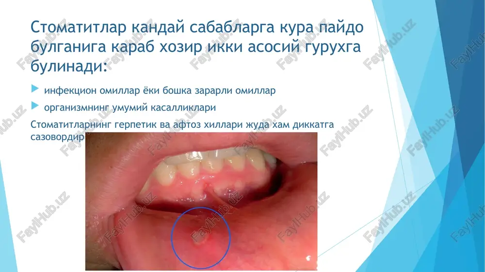 li). surunkali appenditsit sklerotik va atrofik jarayonlar limfogistiotsitar infiltratsiyasi xarakterli. bolalar yoshiga 15% to‘g‘ri keladi. bir yoshgacha kam kuzatiladi. 9 – 12 yoshda kuproq kuzatiladi. erta yoshdagi bolalarda destruktiv o‘zgarishlar, asoratlari bilan tez rivojlanadi. foydalanilgan adabiyotlar: odam patologiyasi asoslari, m. s.abdullaxo‛jayeva, toshkent, abu ali ibn sino nomidagi tibbiyot hlashriyoti 2008 mikrobiologiya, virusologiya, immunologiya, muhammedov, eshboyev, zokirov, toshkent, yangi asr avlodi nashriyoti, 2006 www.ziyonet.uz www.yahoo.uz www.tashpmi.uz e`tiboringiz uchun rahmat! thank you for attention! spasibo za vnimanie! image1.jpeg image2.jpeg image3.jpeg image4.jpeg image5.jpeg image6.png image7.jpeg image8.png image9.jpeg image10.jpeg image11.jpeg image12.jpeg image13.jpeg image14.jpeg image15.jpeg image16.jpeg image17.jpeg image18.jpeg