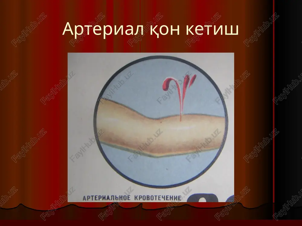 ncha to'xtatish bosib turuvchi bog'lam qo'yish. oyoq yoki qo'lni baland ko'tarish. oyoq yoki qo'l bo'g'imlarini maksimal bukish va boglash. barmoq bilan qon tomirni suyakka bosib turish. rezina tasma / esmarx va boshqa tasmalarni qo'llash/. jaroxatdan qon oqib turgan tomirga qisqich qo'yish. jgut qo'yish lentasimon jgut arteriyalarni bosib turib to'xtatish uchun tegishli nuqtalar arteriyalarni bosib turib qon to'xtatish uchun an'anaviy nuqtalar tirsak yoki kaftdan ketayotgan qonni tirsak bo'g'imidan maksimal bukib, to'xtatish oyoqni maksimal bukish bosib turuvchi bog'lam qo'yib, qonni to'xtatish oyoqni yuqoriga ko'tarib, ketayotgan qonni to'xtatish qon ketishni batamom to'xtatish usullari mexanik usullari. termik usullari. kimyoviy usullari. biologik usullari. qon ketishni to'xtatishning mexanik usullari qon tomirini jaroxatda bog'lash. qon tomirini masofadan bog'lash. qon tomiriga chok qo'yish. bosuvchi bog'lam qo'yish. tamponada. qon tomirini qisqich bilan ushlab, bog'lash qon tomirini atrof to'qimarga chok qo'yib tikish bilan, ketayotgan qonni to'xtatish qon tomirini jaroxatda tikish qon tomirini deshan ignasi bilan bog'lash qon tomirini uzoqdan bog'lash …