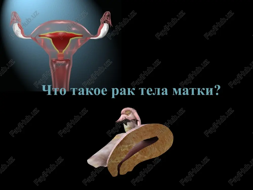 mfogennie metastazi implantatsionniy put v mikroskopicheskaya kartina visokodifferentsirovannaya adenokartsinoma nizkodifferentsirovanniy rak razlichnie mikroskopicheskie varianti raka endometriya klinika matochnie krovotecheniya, kotorie voznikayut u jenshin v menopauze (poyavlenie krovotecheniy posle dolgogo pereriva) dlitelnie i obilnie menstrualnie krovotecheniya u molodix jenshin (ne vstupivshix v period menopauzi). postoyannie noyushie boli v poyasnitse.rak tela matki dlitelnoe vremya mojet protekat bessimptomno, odnako neredko tak je proyavlyaetsya matochnimi krovotecheniyami, bolyami v poyasnitse, libo uvelicheniem razmerov jivota. simptomi intoksikatsii (toshnota, utomlyaemost, slabost). dlitelnaya nemotivirovannaya subfebrilnaya temperatura (37 – 37.5s) stadii i stadiya raka tela matki — opuxol ogranichena endometriem. stadiya ia - opuxol ogranichena endometriem. stadiya ib - invaziya menee chem na 1/2 tolshini miometriya. stadiya 1s - invaziya bolee chem na 1/2 tolshini miometriya. ii stadiya raka tela matki — rak prorastaet endometriy i stromu tservikalnogo kanala. stadiya iia - opuxol zaxvativaet tolko endotservikalnie jelezi. stadiya iib - invaziya v stromu sheyki. stadiya iiia - rasprostranenie opuxoli …