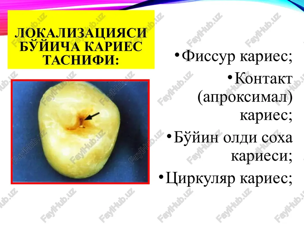 q. 1 – shaffof zona; 2 – to'q (koramtir) zona; 3 – zararlanish tanasi; 4 – yuza zona. dog' bosqichidagi karies dog' bosqichidagi kariesni emal gipoplaziyasi bilan qiyosiy tashxislash: belgilari dog' bosqichidagi karies emal gipoplaziyasi paydo bo'lish vaqti tish chiqqandan keyin tish chiqishigacha zararlangan tishlar xam doimiy, xam vaqtinchalik tishlar. aksariyat xolda doimiy tishlar zararlangan o'choq xususiyati bo'rsimon dog', emal nuqsoni yo'q, yaltiroqligi yo'qolgan. och dog', emal yuzasi o'zgarmagan- silliq, yaltiroq. lokalizatsiyasi fissuralar, tabiiy chuqurliklar, kontakt soha va tish bo'yni. kariesga xos bo'lmagan soxalar. dog'lar miqdori yakka, ayrim xollarda – bir nechta. yakka, sistem zararlanishda ko'p. dog'ning o'zgarish dinamikasi kam xolda yo'qoladi, dog' o'rnida yuza karies vujudga keladi. yo'qolmaydi. 2% metilen ko'ki eritmasi bilan bo'yash. emal zararlangan soxa bo'yaladi. zararlangan soxa bo'yalmaydi. ichimlik suvidagi ftorning miqdori. ftor miqdori suvda kam bo'lganda zararlanish ortadi. axamiyati yo'q. dog' bosqichidagi kariesni flyuoroz bilan qiyosiy tashxislash: belgilari dog' bosqichidagi karies flyuoroz (dog' shakli) paydo …