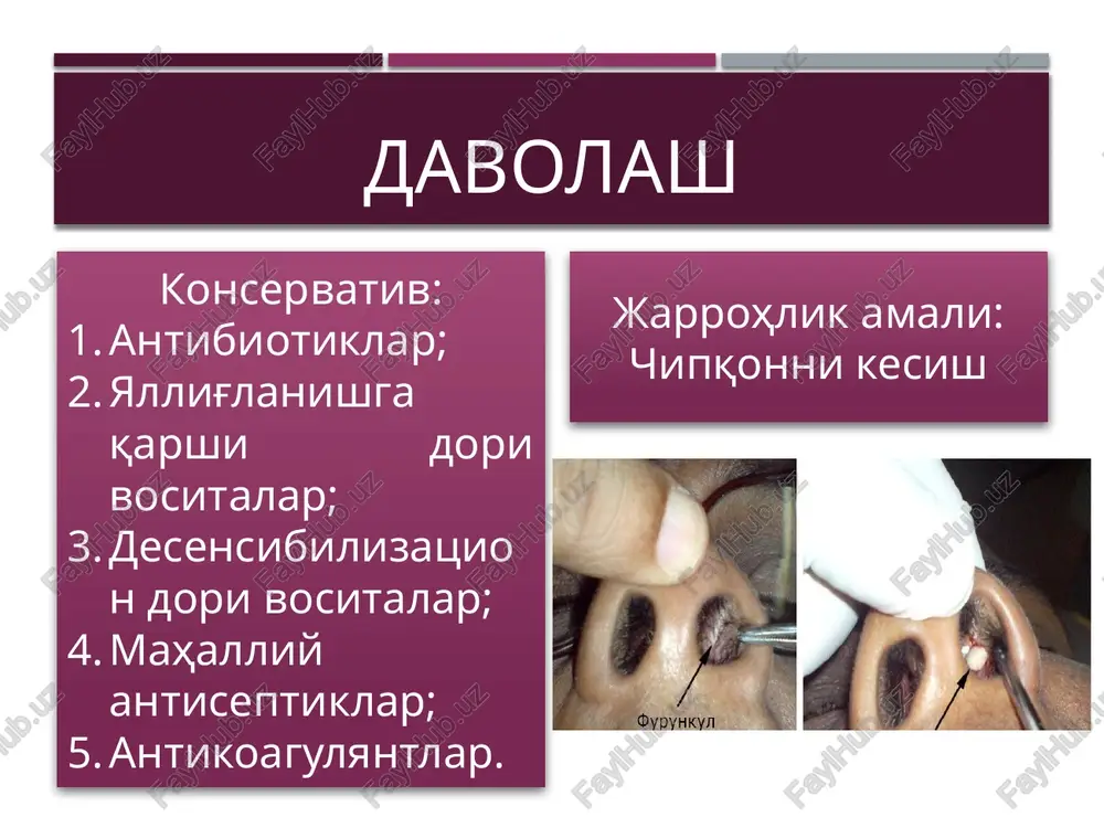 it, ikkinchi o'rinni - bosh miya va miyacha ho'ppozlari, uchinchi o'rinni sigmasimon sinus trombozi va otogen sepsis egallaydi. ba'zan bir nechta kalla ichi asoratlari birga kechishi kuzatiladi. masalan, sigmasimon sinus trombozi, meningit, miyacha va bosh miya ho'ppozlari. yosh bolalarda ko'pincha meningoentsefalit rivojlanadi. etiologiyasi o'tkir o'rta otit - s. pneumoniae surunkali o'rta otit - pseudomonas - fusobacterium - bacteroides - h. influenzae - m. catarrhalis - s. pyogenes - s. aureus - esherichia coli - anaerobic flora - s.pneumoniae - klebsiella - s. aureus - peptococcus - proteus - lactobacillus miya chanog'iga infektsiyalarni o'tish yo'llari kontakt yo'li shakllangan yo'llari orqali (preformirovanniy) labirint orqali qon orqali limfa orqali tirqishlar (degistsentsiya) orqali infektsiyaning tarqalish etaplari ekstradural abstsess subdural abstsess yiringli meningit bosh miya yarim sharlari va miyacha abstsesslari ekstradural abstsess ekstradural abstsess – yiring qattiq miya pardasi va suyak orasida to'planishi. bu – yallig'lanish jarayonini so'rg'ichsimon o'siq va nog'ora bo'shlig'idan miya chanog'i bo'shlig'iga …