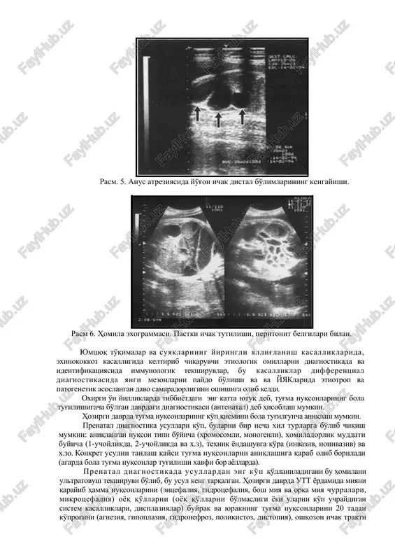 sistem kasalliklari, displaziyalar) buyrak va yurakning tug'ma nuqsonlarini 20 tadan ko'prog'ini (agneziya, gipoplaziya, gidronefroz, polikistoz, distopiya), oshqozon ichak trakti atreziyasi, kindik tizimchasi va diafragmal churralar, ichki a'zolarni anomal joylashuvi, a'zolardagi kistoz hosilalarini va boshqa ko'plab holatlarni yuqori aniqlikda baholash mumkin. aniqlanadigan tug'ma nuqsonlar soni amaliy tajribalar va ultratovush texnikasi rivojlanishi tufayli ko'payib bormoqda. albatta, tug'ma nuqsonlarni turli formalari, turli davrlarda aniqlanadi. masalan anentsefaliya 12 haftadan boshlab aniqlansa, gidronefrozni aniqlash kechroq davrlarda olib boriladi. bir xil nuqsonlar (omfalotsele, churralar) bir marotaba tekshiruvlarda aniqlansa, boshqa (mikrotsefaliya) nuqsonlar faqat dinamik tekshiruvlar natijasida aniqlanadi. ko'p hollarda utt nuqsonni tug'ri aniqlab bersa, boshqa hollarda bemorlarni tekshiruvlarni davom ettirish uchun tanlashga yordam beradi. masalan, bo'yin burmalarini qalinlashuvi, ko'plab xromosom etiologiyali bir qator sindromlarda uchrashi, tsitologik tekshiruvlar o'tkazish uchun ko'rsatma bo'lib, ko'proq daun kasalligida kuzatiladi. tug'ma nuksonlar bilan tug'ilishi xavfi ko'proq bo'lgan oilalarda, ultratovush tekshiruvlar o'tkazilib, xomiladorlikni u yoki bu muddatlarida, baholanishi lozim. shu bilan birga tug'ilishlargacha …