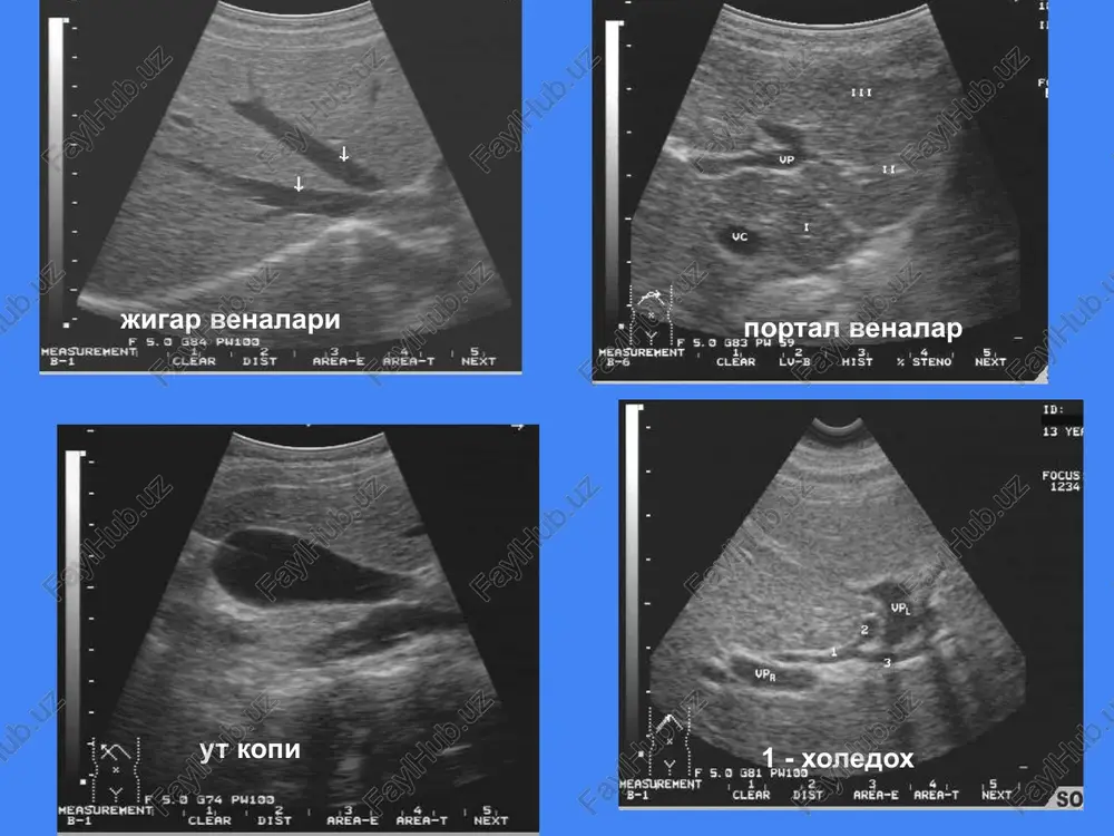 varikozlarni embolizatsiya, portokaval shunt urnatish. portal gipertenziya splenomegaliya astsit varikoz portal va talok venasi kengayishi portal venada kon sekinlashishi va orkaga kaytishi jigar venasida 1 fazali okim (normada 2 fazali) kt-angiografiya va noinvaziv mr-angiografiya portal gipertenziyada varikoz venalarni yaxshi tasvirlaydi yogli distrofiya diffuz eki uchokli bulishi mumkin gepatomegaliya (80%) sg - «yarkiragan» jigar, ultratovush utishi pasayadi, jigar orkasi va kon-tomirlar yaxshi kurinmaydi kt - jigar zichligi +30n kam (tasdiklaydi!!) jigar funktsiyasi kupincha saklangan jigar kistalari 1) oddiy 2) exinokokk 3) polikistoz sg - 1) yumalok gipoexogen tuzilma 2) chegarasi tekis 3) devori yupka/yuk 4) «tovush yuli» simptomi 5) atrof tukimalar normal kt - 1) zichligi +20n gacha (gipodensiv) kt+kontrast - kontrast yigmaydi 1,3 kuprok aellarda 1,2 ulchami katta bulishi mumkin polikistoz abstsess sg - 1) yumalok, gipoexogen 2) devori kalin 3) suyuklik nogomogen va zichrok kistaga nisbatan 4) ichida gaz 5) atrofida shish+infiltratsiya 6) «tovush yuli» simptomi kt - +20+30n …