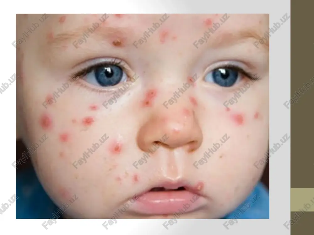 ydo bo‘lsa, impetigodek davolang. ♦ dog‘larga quyosh nuri tushsin. ♦ og‘ir hollarda 1% li gidrokortizon mazidan(surtmasidan) foydalaning. tibbiy xodimdan maslahat oling e’tiboringiz uchun raxmat. image2.png image3.png image4.png /docprops/thumbnail.jpeg