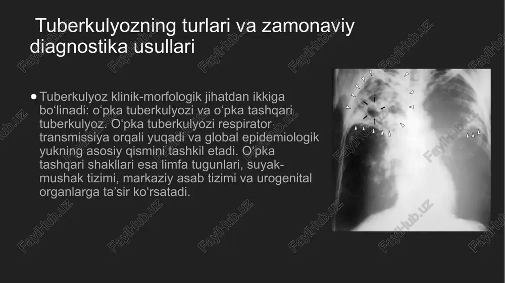 hini 90% ga, o‘lim darajasini esa 95% ga kamaytirishni maqsad qiladi. bu strategiya quyidagi asosiy yo‘nalishlarni qamrab oladi: sog‘liqni saqlash tizimini mustahkamlash – barcha bosqichlarda tuberkulyoz bilan kasallanganlarni qamrab olish va davolash. innovatsion dori va vaksinalarni rivojlantirish – yangi tb vaksinalarining klinik tadqiqotlari va universal foydalanish uchun ishlab chiqarish. global monitoring va moliyaviy ta’minot – xalqaro donorlar va davlat investitsiyalari orqali tuberkulyozga qarshi kurashning samaradorligini oshirish. o‘zbekiston respublikasi milliy strategiyasi: populyatsion skrining dasturlarini kengaytirish – xavf ostidagi guruhlarda tbni erta aniqlash. antituberkulyoz xizmatlarini integratsiyalash – umumiy tibbiyot amaliyotiga tbga qarshi kurash tizimini tatbiq etish. bemorlarni ijtimoiy qo‘llab-quvvatlash dasturlari – dori terapiyasiga rioya qilishni rag‘batlantirish uchun ijtimoiy yordam mexanizmlarini joriy etish. 📌xulosa tuberkulyoz nazorati samaradorligi diagnostika, davolash va monitoring tizimlarining uzviy integratsiyasiga bog‘liq. jsst tavsiyalariga asoslangan yondashuvlar tuberkulyoz yukini kamaytirish va uning tarqalishini oldini olishda muhim o‘rin tutadi. global va milliy strategiyalarning sinergiyasi kelajakda tuberkulyozning bartaraf etilishiga asos bo‘lishi mumkin. foydalanilgan …