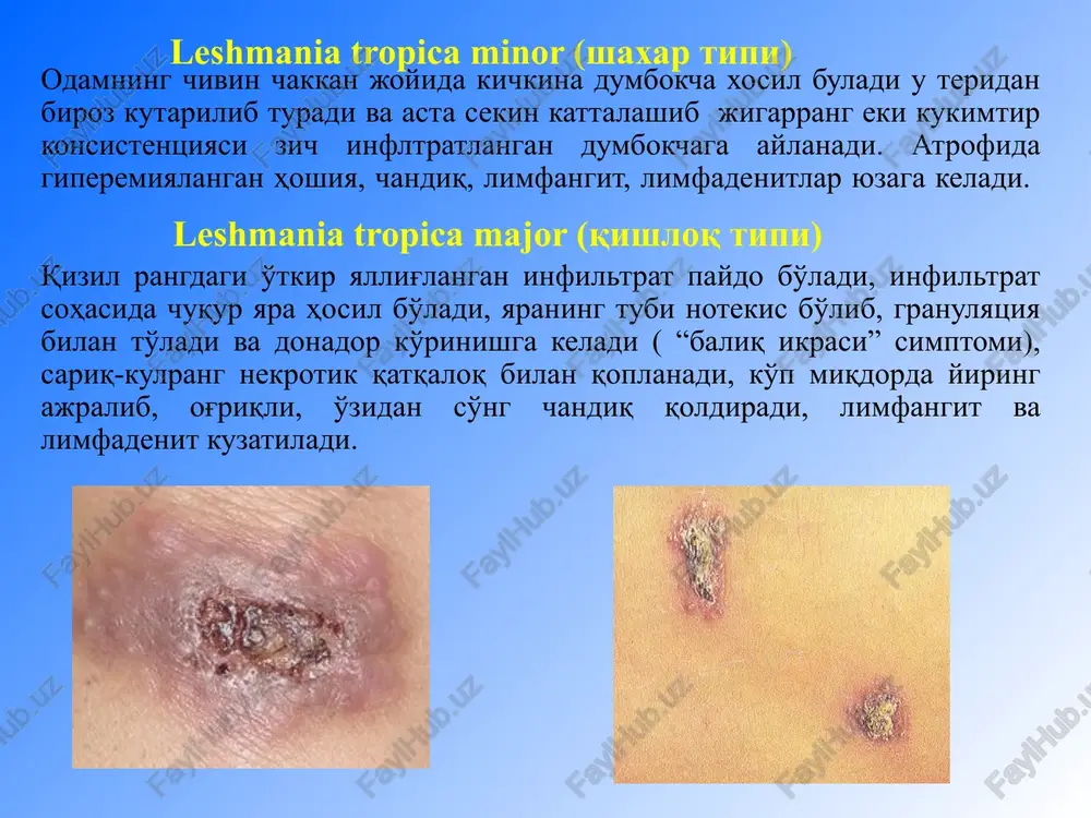er ajralishi, og'riqli, taktil buzilishlar limfa tugunlari kattalashishi, orxiepidedimitlar. moxovning differentsiyalanmagan turi aniq chegarali eritematoz-skvamoz va disxromik dog'lar, ter ajralishining buzilishi, qosh va kipriklarning to'kilishi, tirnoqlar atrofiyasi, bo'g'imlar atrofida pufaklar, yaralar, mayda suyaklar sekvestratsiyasi, mutilyatsiya, yuz mushaklari amiotrofiyasi, nevritlar, paresteziya, taktil og'riqlar, harorat sezgisining buzilishi. davolash va tekshiruv usullari nevrologik statusni tekshirish. funktsional sinamalar. bakterioskopiya. gistologik tekshiruv. sulfon preparatlari: diaminodifenilsulfon (dds) . antibiotiklar: ftorxinolonlar, makrolidlar, tetratsiklinlar v, s guruh vitaminlar, nikotin kislota gepatoprotektorlar vitiligo – aniq chegarali, atrofi giperpigment hoshiyali va periferik o'sishga moil oq dog'lar paydo bo'lishi bilan kechuvchi surunkali dermatoz. klassifikatsiya: chegaralangan (3%dan ko'p bo'lmagan) a) fokal b) segmentar tarqoq (3-10%) generalizatsiyalashgan ( 10% yukori) setton kasalligi kasallikka sabab buluvchi faktorlar: stress intoksikatsii jigar kasalliklari endokrin ksalliklari immunodefitsit xolat irsiy moillik chegaralangan (3%dan ko'p bo'lmagan) a) fokal b) segmentar ‹#› tarqoq (3-10%) generalizatsiyalashgan (10% yukori) settona kasalligi kasallikning aktivlik darajasi vida (vitiligo desease acnivity) indeksi bo'yicha ballarda o'lchanadi …