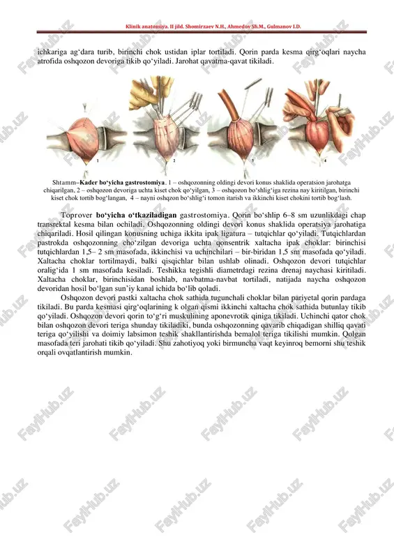 iqarish, 6 – ushlagich iplarni teriga tikish (nayni fiksatsiyalash). shtamm–kader bo‘yicha gastrostomiyada yuqori o‘rta laparotomiya qilinganidan keyin oshqozonning oldingi devori jarohatga chiqariladi va bir-biridan 2–3 sm o‘zoqlikda ikkita ligatura– tutqich qo‘yiladi. tutqichlar oralig‘iga seroz-muskul xaltacha choki qo‘yiladi, uning markazida skalpel bilan oshqozon devori teshiladi, unga rezina naycha kiritiladi va uning atrofida xaltacha chok tortiladi. birinchi xaltacha chokdan 1 sm tashlab, xuddi shunaqa ikkinchi chok qo‘yiladi va oshqozon devorini klinik anatomiya. ii jild. shomirzaev n.h., ahmedov sh.m., gulmanov i.d. ichkariga ag‘dara turib, birinchi chok ustidan iplar tortiladi. qorin parda kesma qirg‘oqlari naycha atrofida oshqozon devoriga tikib qo‘yiladi. jarohat qavatma-qavat tikiladi. shtamm–kader bo‘yicha gastrostomiya. 1 – oshqozonning oldingi devori konus shaklida operatsion jarohatga chiqarilgan, 2 – oshqozon devoriga uchta kiset chok qo‘yilgan, 3 – oshqozon bo‘shlig‘iga rezina nay kiritilgan, birinchi kiset chok tortib bog‘langan, 4 – nayni oshqzon bo‘shlig‘i tomon itarish va ikkinchi kiset chokini tortib bog‘lash. toprover bo‘yicha o‘tkaziladigan gastrostomiya. qorin …