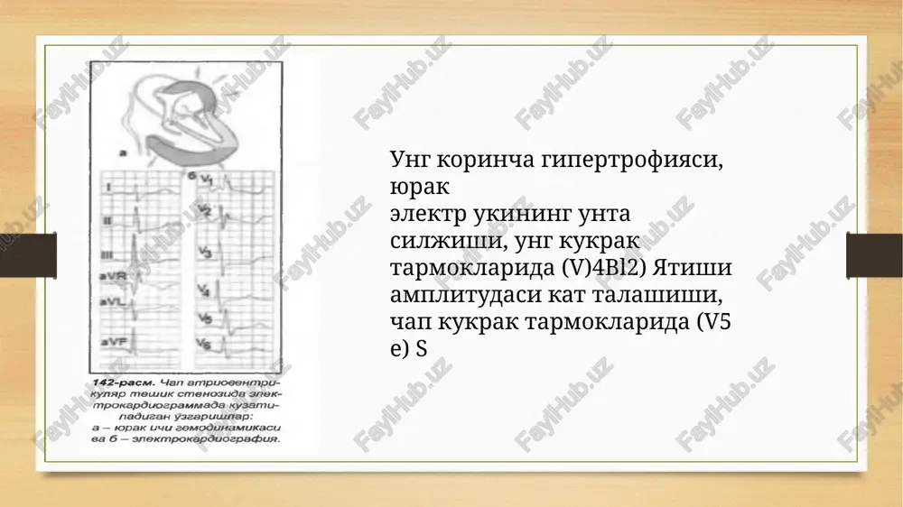 andlashishi va ung kukrak tarmoklarida (v,^) s tishchasining chukurlashishi (144 v, g-rasm) aorta ravogi torayishining (stenozi) ekg belgilari. aorta ning yakka kolda uchrovchi stenozi chap korinchaning yakkol namoyon bulgan giper trofiyasiga olib keladi (145 a, b-rasm) va kuyidagi ekg belgilari bilan na moyon buladi: sistolik zurikishi bilan ke chuvchi chap korincha gipertrofiyasi, ya'ni chap kukrak tarmoklarida ( v j r tishchasi amplitudasining yukoriligi va ung kukrak tarmoklarida (v12) s tishchasining chukurlashishi kamda kup kollarda i, avl, tarmoklarda rs-t segmenti ning depressiyasi va ikki faza li (±) yoki manfiy t tishchaning shakplanishi; ba'zi kollarda gis tu tami chap oyokchasining tulik yoki tulik bulmagan blokadasi; ichki ogish davomiyli gining tarmoklarda 0,05 soniyadan kup bulishi. aorta krptsotschapari etishmovchiligining ekg bel gilari. ushbu nukson kam aor ta ravogi stenozi kabi chap korincha gipertrofiyasi va di latatsiyasi bilan birga kechadi (145 v, g-rasm). pekin undan farkpi ularok chap korinchani sistolik emas, balki diastolik zurikishi kuzatiladi …