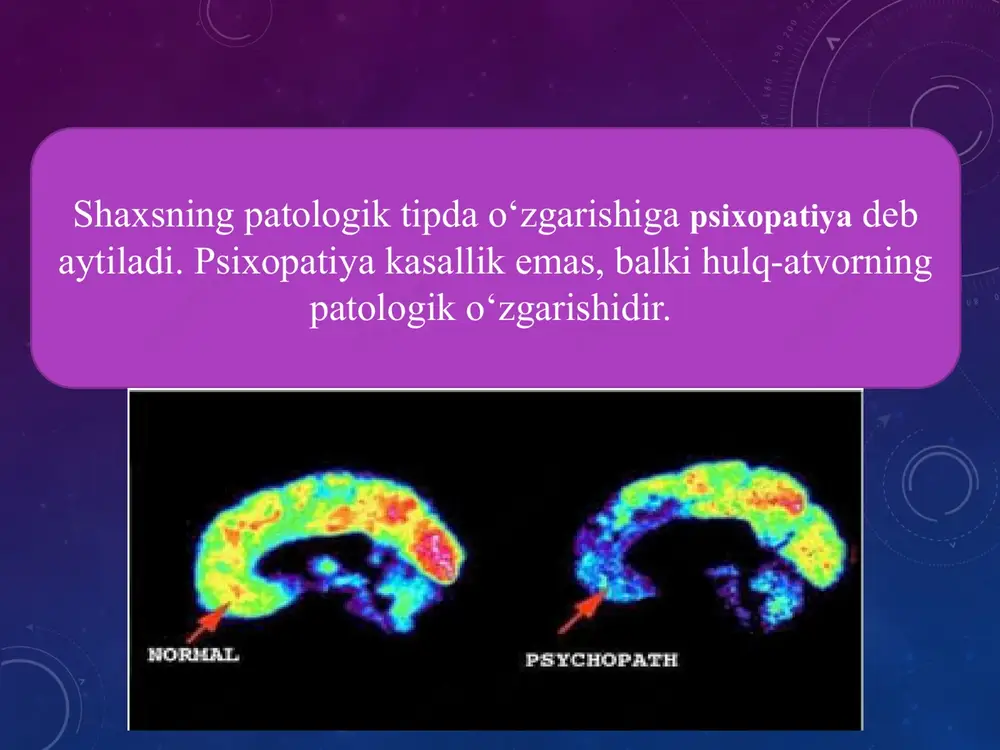 arhol qoniqish talabi va agressiv xatti-harakatlarni namoyon qilish. pcl-r factor 2 va ppi kabi impulsiv antisotsializmga oʻxshashdir. bunday nazorat bilan shugʻullanadigan frontal lob tizimlaridagi buzilishlarga mos kelishi mumkin shafqatsizlik boshqalarga nisbatan hamdardlikni his qilmaslik va yaqin munosabatda boʻlmaslik, yaqin bogʻlanishni mensimaslik, o'z maqsadiga erishish yo'lida shafqatsizlikdan foydalanish, ekspluatatsiya qilish tendensiyalari, hokimiyatga boʻysunmaslik va halokatli hissiyotlarga berilish shaklida namoyon bo'ladi. umuman olganda, pcl-r bu bilan bogʻliq, lekin, xususan, 1-omilning baʼzi elementlari ppiga oʻxshash, ammo impulsiv antisotsiallikdagi kichik oʻlchovlar elementlarini ham oʻz ichiga oladi shaxsiy oʻlchovlar tadqiqotlar psixopatiya tushunchasini antagonizm (yuqori), vijdonlilik (past) va tashvish (past) kabi muqobil oʻlchovlar bilan bogʻlaydi psixopatiya yuqori psixotizm bilan ham bogʻlangan — bu nazariy jihatdan qoʻpollik, tajovuzkorlik yoki dushmanlik tendensiyalariga ishora qiladi. psixotizmning psixopatiya bilan bogʻliq koʻrinadigan jihatlari ijtimoiylashuv va mas’uliyatning yetishmasligi, impulsivlik, sensatsiyagaa oʻchlik va tajovuzkorlik hisoblanadi otto kernberg, maʼlum bir psixoanalitik nuqtai nazardan, psixopatiyani patologik narsissizm spektrining bir qismi sifatida koʻrib chiqish kerak deb …