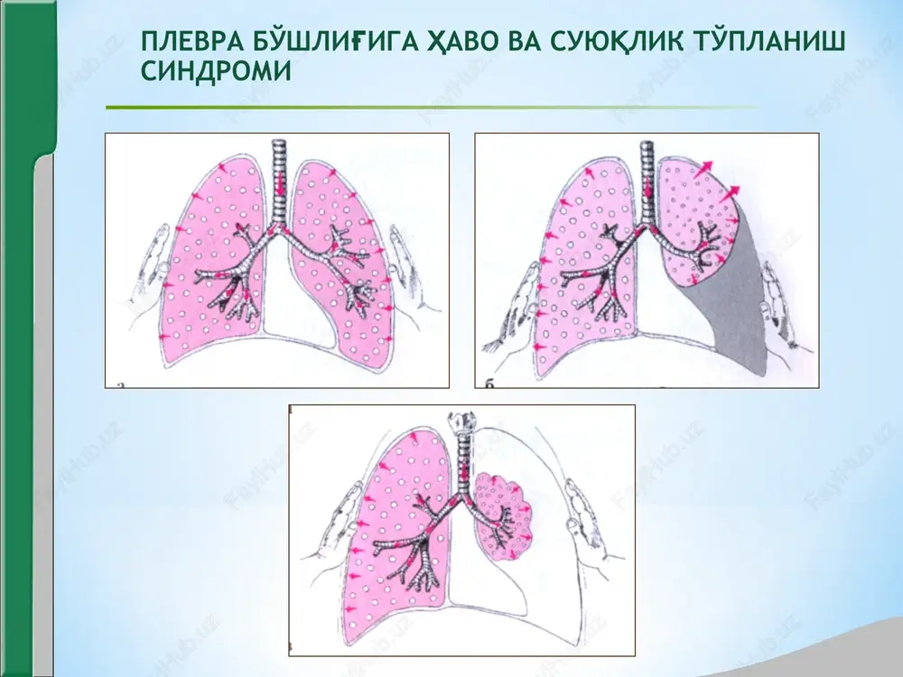 aniklash uchun plevra bushligi punktsiya kilinadi. o'pkada bo'shliq hosil bo'lish sindromi fibroz tukima va infiltrat bilan uralgan, zich va sillik devorli bushliklarning xosil bulishi(kaverna, abstsess, kista). simptomlar kuyidagilarga boglik: -bushlikning xajmi; -joylashish chukurligi; -tarkibi; -bushlikning nafas yullari bilan alokasi. sabablari: upka infiltratining tarkalishi (surilishi): - abstsesslanuvchi zotiljam; - abstsesslanuvchi upka infarkti; - upkaning kavernali sili; - granulematoz uchok. patogenezi: asosiy kasallikka tegishli o'pkada bo'shliq hosil bo'lish sindromi klinik manzarasi. surab-surishtirish: aralash tipdagi xansirashga shikoyatlar ertalablari ogiz tula kulansa xidli balgam ajralishi bilan kechadigan yutal, ma'lum vaziyatlarda bushlikni bushalishi tufayli balgam ajralishi kuchayadi. kuzdan kechirish: kovurgalararo oralik, nafas aktlarida kukrak kafasi bir kismining orkada kolishi,nafas soni kupaygan, katta bushlik bulganda uni ustida kukrak kafasi ichiga tortilgan, toraygan buladi. palpatsiya: kasallangan tamonda kukrak kafasi elastikligi susaygan, bushlik ustida ovoz dirillashi kuchaygan (bushlik atrofida yalliglanish tufayli). perkussiya: kiyosiy – bushlik joylashgan kismda timpanik tovush, periferiyada bugiklashgan. topografik – kasallangan tomonda upkaning pastki kirrasi …