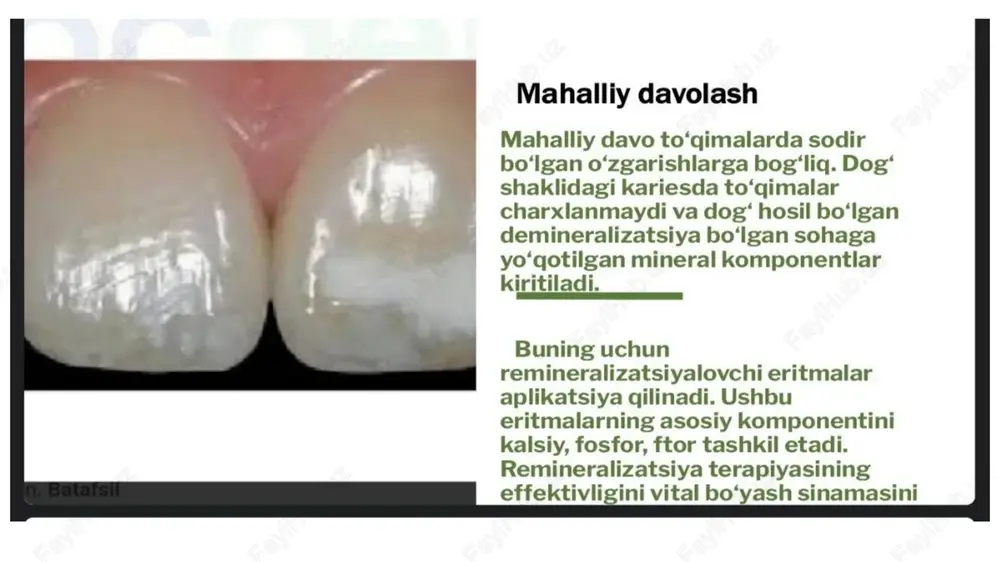 kariyesni mahalliy davolash usullari - Page 3