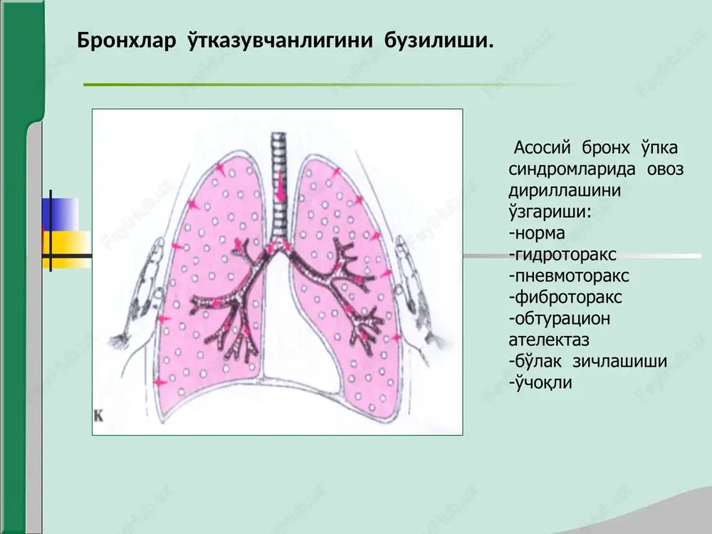imni odatdagidan bir necha bor oshib ketishiga olib keladi, bu esa o'z navbatida alveolalar devorini haddan tashqari cho'zilishiga olib keladi -alveola devorini elastikligi yuqoladi -qoldiq havo miqdori yana ortib ketadi -o'pka to'qimasi shishirilgan holga keladi, o'pkada havoni ortib ketishi sindromi yuzaga keladi. o'pka to'qimasida havoni ortishi sindromi klinik manzarasi. -umumiy ko'zdan kechirish – majburiy holat, maksimal nafas olish fazasi holatida bochkasimon ko'krak qafasi, nafas muskullarini faollashishi, ekspirator xarakterdagi xansirash, burun, quloq tsianozi, aakrotsianoz, “baraban tayoqchalari”, “soat oynasi” simptomi. -palpatsiya – ko'krak qafasi elastikligi susaygan. -taqqoslama perkussiya – qutichasimon tovush. -topografik perkussiya – o'pkani yuqorigi, pastki chegaralari, krenig* maydoni kengaygan, o'pka ekskursiyasi cheklangan. -auskultatsiya – vezikulyar nafas susaygan, - nafas chiqarish uzaygan, - quruq cho'ng'illovchi, hushtaksimon xirillashlar, - bronxofoniya susaygan. o'pka to'qimasida havoni ortishi sindromi laborator – instrumental tekshirish natijalari. -qon analizi: leykotsitoz, leykotsitar, -formulani chapga siljishi, -echt ortishi -limfotsitoz -eozinofiliya -balg'am analizi: -shilliq yoki shilliq – yiringli -mikroskopiya – leykotsitlar …