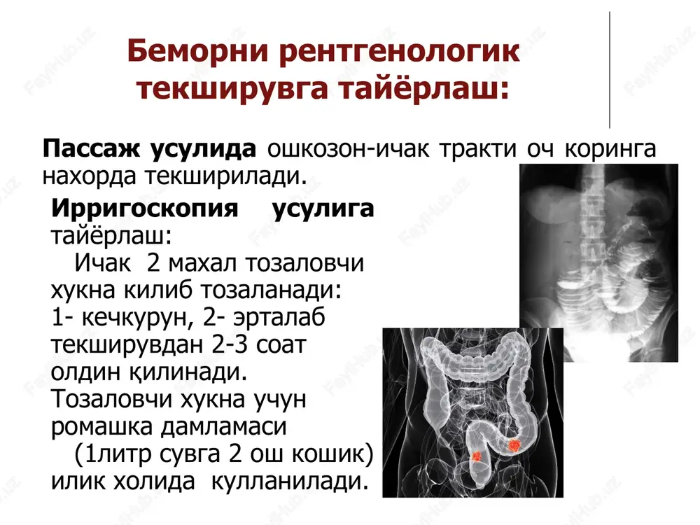 zolarining siljish sindromi vi. xazm kanali a'zolarida yot jism sindromi qizilo'ngach kasalliklari: qizilo'ngach axalaziyasi qizilo'ngach atreziyasi qizilo'ngach venalarining varikoz kengayishi qizilo'ngach divertikuli qizilo'ngachda yot jism qizilo'ngach kuyishi qizilo'ngach o'smalari ‹#› qizilo'ngach axalaziyasi - kardiospazm qizilo'ngach kardial qismi innervatsiyasining buzilishi. 4ta bosqichi bor: 1-bosqich: kardiyaning qisqa spazmi, qizilo'ngach kengaymagan, peristaltika oddiy. 2-bosqich: kardiyaning turg'un spazmi, bariy sufat qizilo'ngachdan sekin o'tadi, qizilo'ngach kengaygan, peristaltika kuchaygan, tonus avvalgidek. 3-bosqich: qizilo'ngach kengayadi, uzayadi va egiladi, bariy sulfat ushlanib qoladi. 4-bosqich: qizilo'ngach keskin kengaygan ko'ndalang o'lchami ba'zida 15 sm va undan ko'proq,, atonik, och qoringa qizilo'ngachda juda ko'p suyuqlik va ovqat qoldiqlari, bariy sulfat uzoq ushlanib koladi. kardial segmenti toraygan, chegaralari tekis, “sabzi uchi” yoki “sichqon dumi” ni eslatadi, yutish vaqtida xam ochilmaydi, ezofagit belgilari ko'rinadi. reflyuks-ezofagit asorati qizilo'ngach atreziyasi qizilo'ngachning to'liq tug'ma tutilishi. yutqinda xavo va suyuqlik satxi aniqlanadi. oshqozon ichak traktida xavo aniqlanmaydi. qizilo'ngach venalarining varikoz kengayishi rentgenologik belgilari: qizilo'ngach konturlari notekis, mayda …