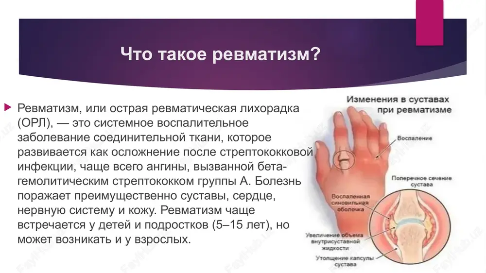 chaetsya dlitelnaya profilaktika antibiotikami (naprimer, bitsillin-5) v techenie neskolkix let, chtobi predotvratit povtornie streptokokkovie infektsii. nemedikamentoznie rekomendatsii - rejim i otdix: - rejim i otdix: v ostroy faze zabolevaniya vajen postelniy rejim, chtobi snizit nagruzku na sustavi i serdtse. postepenno mojno vozvrashatsya k umerennoy aktivnosti. - dieta: rekomenduetsya sbalansirovannoe pitanie, bogatoe vitaminami (osobenno vitaminom s) i mineralami. ogranichte potreblenie soli i jirnoy pishi, chtobi snizit nagruzku na serdtse i sosudi. polezni produkti s omega-3 jirnimi kislotami (riba, lnyanoe maslo). nemedikamentoznie rekomendatsii - rejim i otdix: - fizioterapiya: posle snyatiya ostrogo vospaleniya naznachayutsya fizioterapevticheskie protseduri (naprimer, magnitoterapiya, elektroforez) i lechebnaya fizkultura dlya vosstanovleniya podvijnosti sustavov. - sanatsiya infektsiy: vajno vilechit vse ochagi xronicheskoy infektsii (karies, tonzillit), chtobi predotvratit retsidivi. profilaktika oslojneniy revmatizm opasen svoimi oslojneniyami, osobenno porajeniem serdtsa (revmaticheskiy porok serdtsa). poetomu: - regulyarno poseshayte kardiologa i revmatologa. - izbegayte pereoxlajdeniy i infektsiy. - svoevremenno lechite lyubie angini ili drugie streptokokkovie …