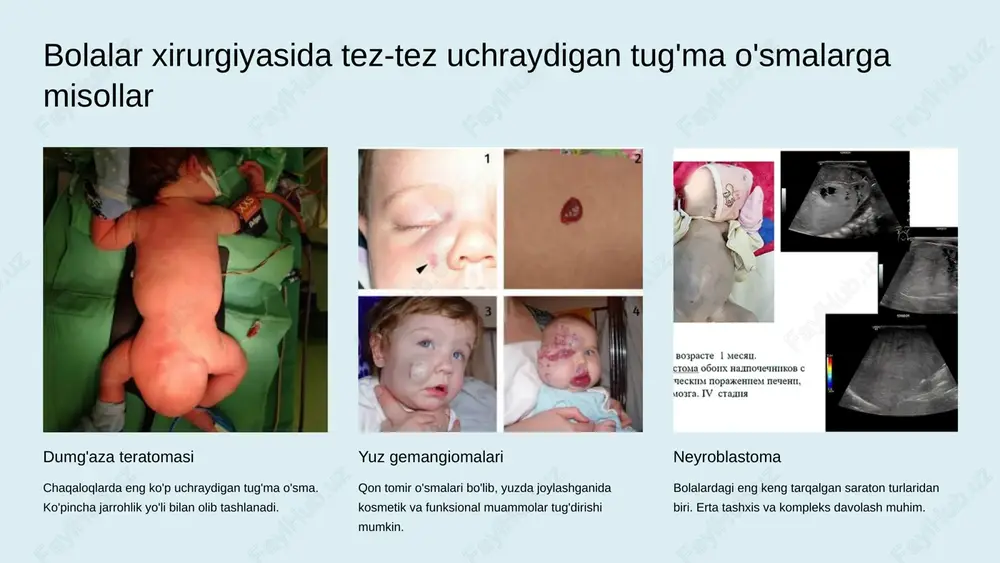 rak tashqarisiga chiqib, yaqin limfa tugunlari va qorin bo‘shlig‘idagi boshqa organlarga tarqaladi; to‘liq jarrohlik olib tashlash imkoni yo‘q. • iv bosqich: uzoq metastazlar yuzaga keladi (masalan, o‘pka, jigar, markaziy asab tizimi yoki suyaklarga). • v bosqich: o‘sma ikkala buyrakni ham zararlaydi. gistologik tuzilishi bo‘yicha: • qulay (kam malign) – ko‘proq uchraydi. • noqulay (anaplastik) – kamroq uchraydi, ammo prognozi yomonroq. bolalarda uchrashi mumkin bo‘lgan boshqa buyrak o‘smalari (masalan, yorqin hujayrali sarkoma, malign rabdoid o‘sma) nefroblastomaga qaraganda og‘irroq prognozga ega va ko‘proq intensiv davolashni talab qiladi. etiologiyasi tadqiqotlar shuni ko‘rsatadiki, ayrim genlar va xromosomalar o‘zgarganda, o‘smaning paydo bo‘lishiga ta’sir qiladi. bugungi kunda eng ko‘p o‘rganilgan gen – bu 11-xromosomada joylashgan vilms o‘smasi geni 1 (wt1 geni) hisoblanadi. u bolalarda buyraklarning normal rivojlanishi uchun juda muhimdir. agar unda o‘zgarishlar yuz bersa, o‘sma va/yoki boshqa tug‘ma nuqsonlar (anomaliyalar) paydo bo‘lishi mumkin. olimlar shuningdek, 11-xromosomada va boshqa xromosomalarda joylashgan boshqa genlarni ham topgan, ular …