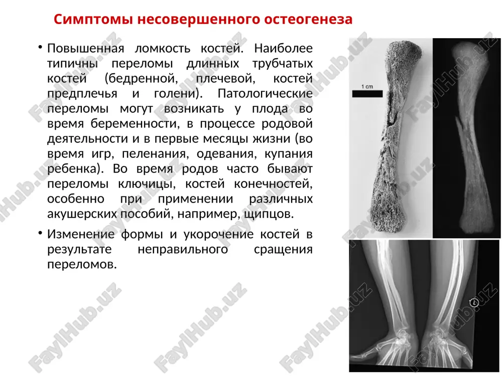 li slyuni s tselyu viyavleniya mutatsiy, xarakternix dlya zabolevaniya). vozmojna takje konsultatsiya terapevta, travmatologa-ortopeda. lechenie nesovershennogo osteogeneza tak kak dannoe zabolevanie yavlyaetsya nasledstvennim, to primenyayut tolko simptomaticheskie metodi lecheniya. v pervuyu ochered medikamentoznaya terapiya doljna bit napravlena na usilenie obrazovaniya glavnogo belka kostnoy tkani – kollagena. stimulyatorom yavlyaetsya somatotropin, parallelno s nim naznachayut antioksidanti, soli kaltsiya i fosfora, vitamin d2. posle okonchaniya kursa lecheniya somatotropinom naznachayut stimulyatori mineralizatsii kostnoy tkani (gormoni parashitovidnix jelez) i polivitaminnie preparati. takje ispolzuyut fizioterapevticheskie metodi lecheniya (elektroforez s solyami kaltsiya – proniknovenie lekarstvennogo veshestva v organizm cheloveka pod deystviem elektricheskogo polya), massaj, lechebno-profilakticheskuyu fizkulturu. v tyajelix sluchayax dlya ustraneniya deformatsiy (izmenenie formi i razmera) konechnostey pokazano operativnoe vmeshatelstvo. pokazaniem k xirurgicheskoy korrektsii yavlyayutsya ugloobraznie iskrivleniya segmentov konechnostey so znachitelnim umensheniem ix razmera. v dannom sluchae pribegayut k osteotomii (rassechenie kosti s tselyu ustraneniya nepravilnoy formi) s razlichnimi variantami osteosinteza (sopostanovlenie kostnix otlomkov pri pomoshi razlichnix …